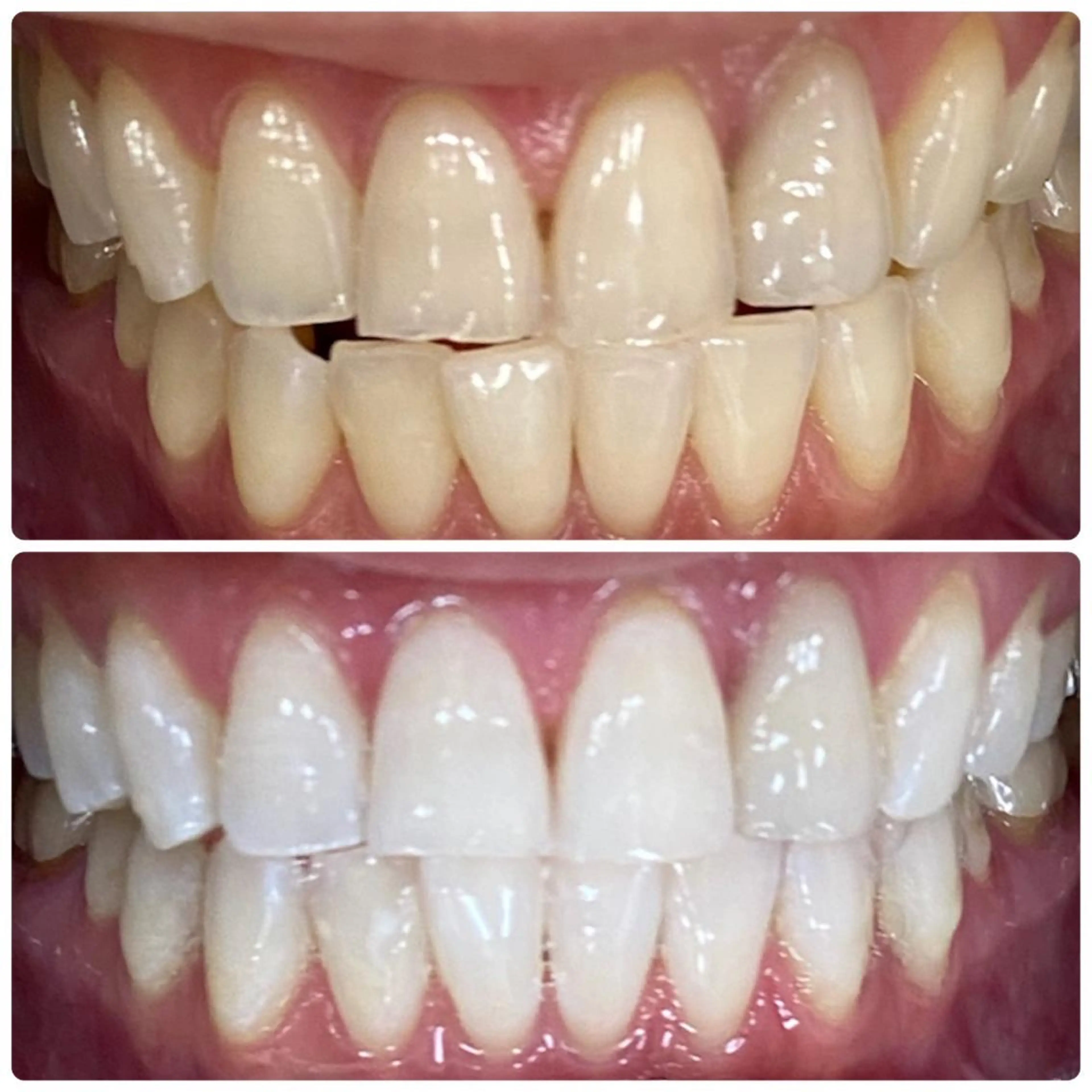 【期間限定】初回6トーンアップ！セルフホワイトニング🦷30分照射⭐️の写真