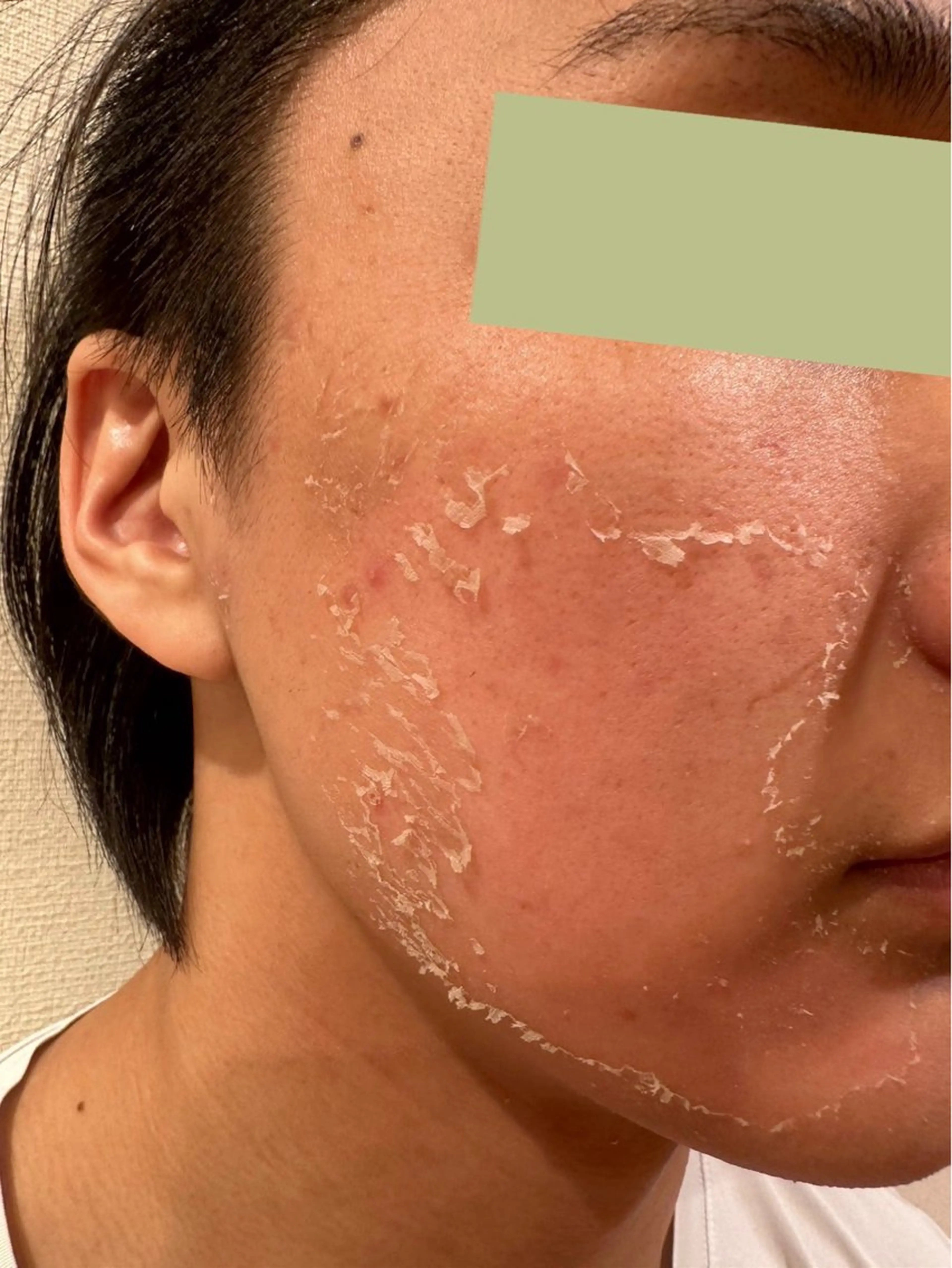 ハーブピーリング肌 管理🌿Ante関内のエステ・リラクイメージ