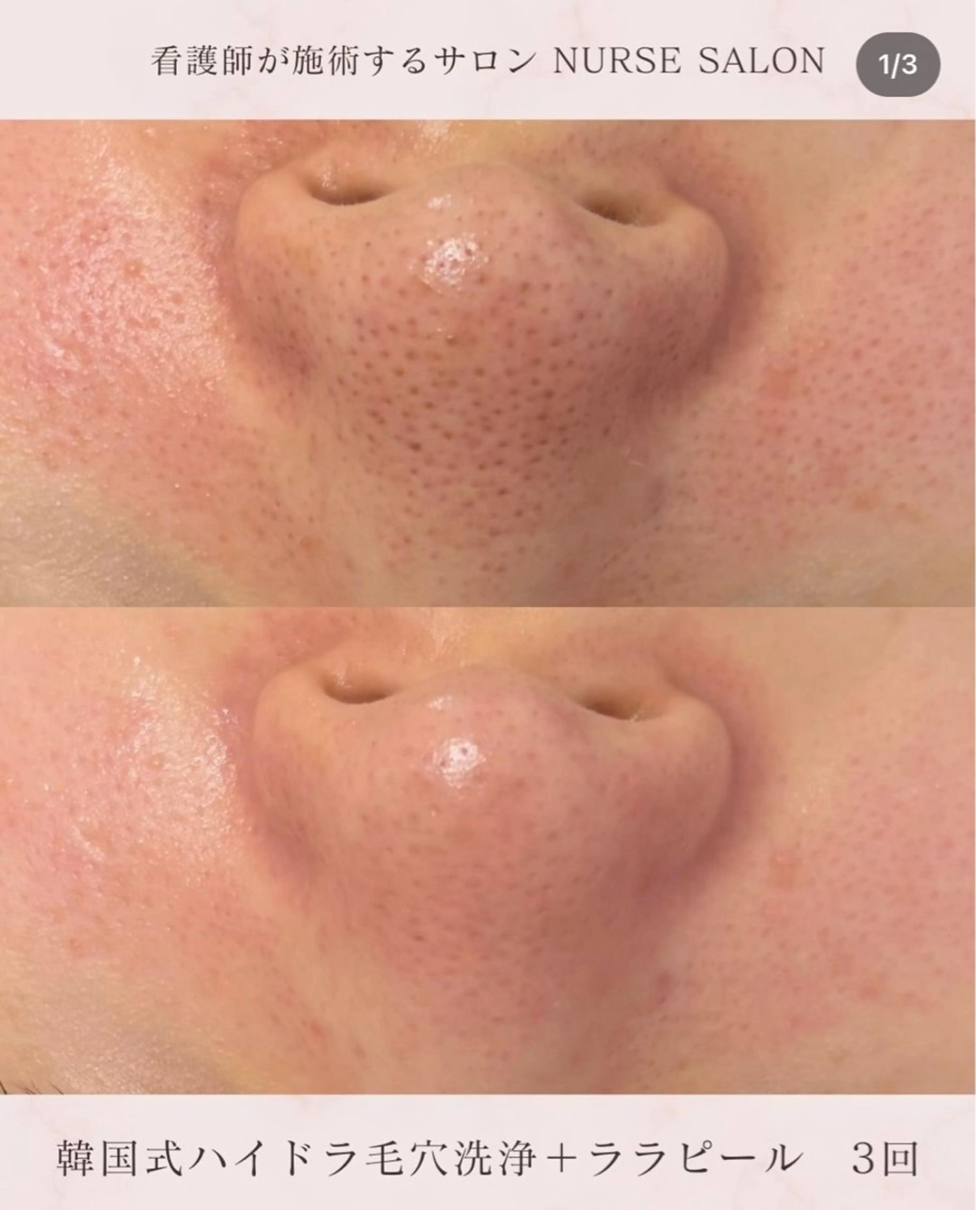 美肌・小顔専門🪄 看護師施術/松﨑のエステ・リラクイメージ