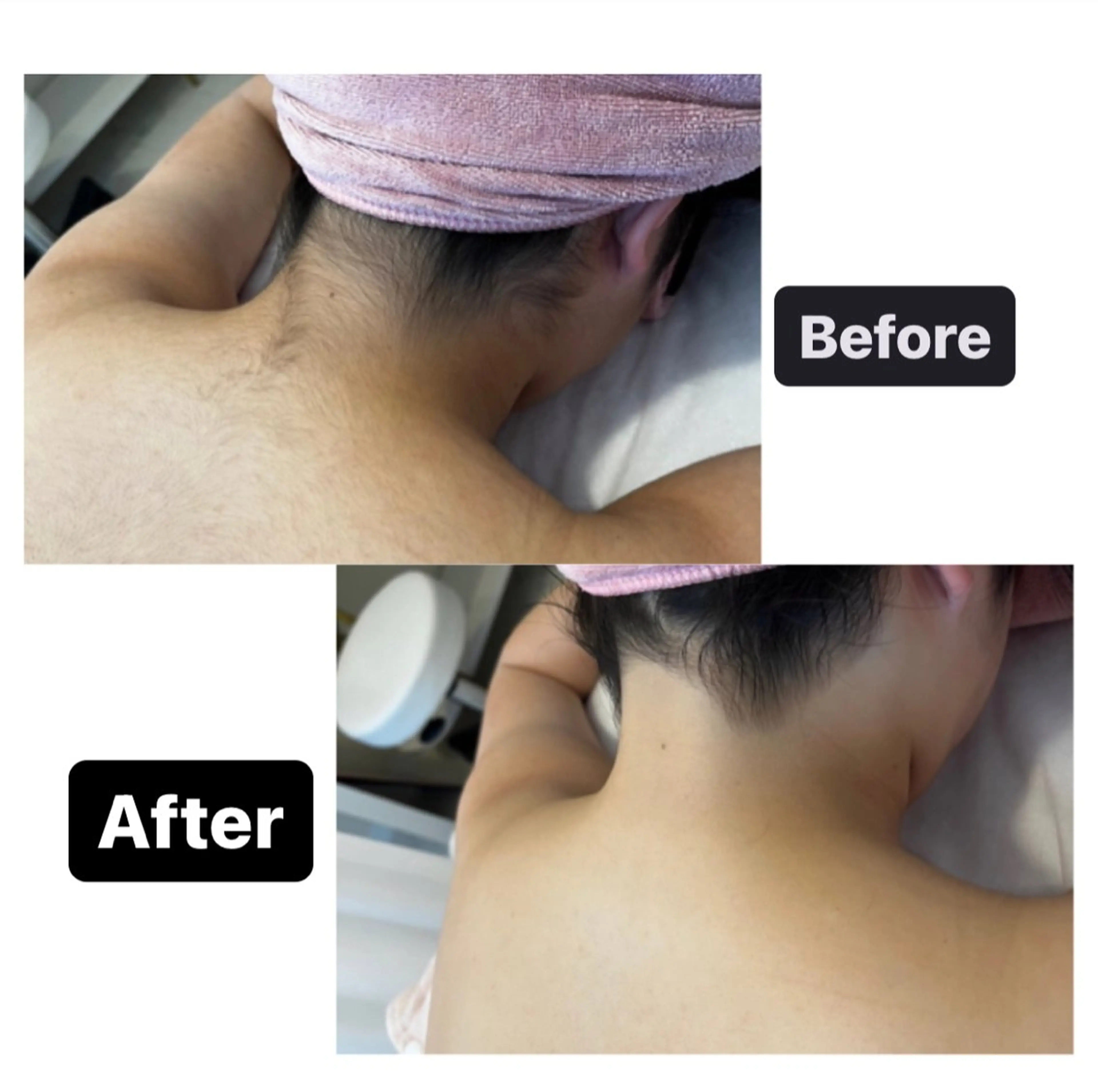 【うなじ脱毛】シェービング付💓手が届かない場所だからこそプロにお任せ下さい💁‍♀️成人式やイベント前にオススメ🪞✨の写真