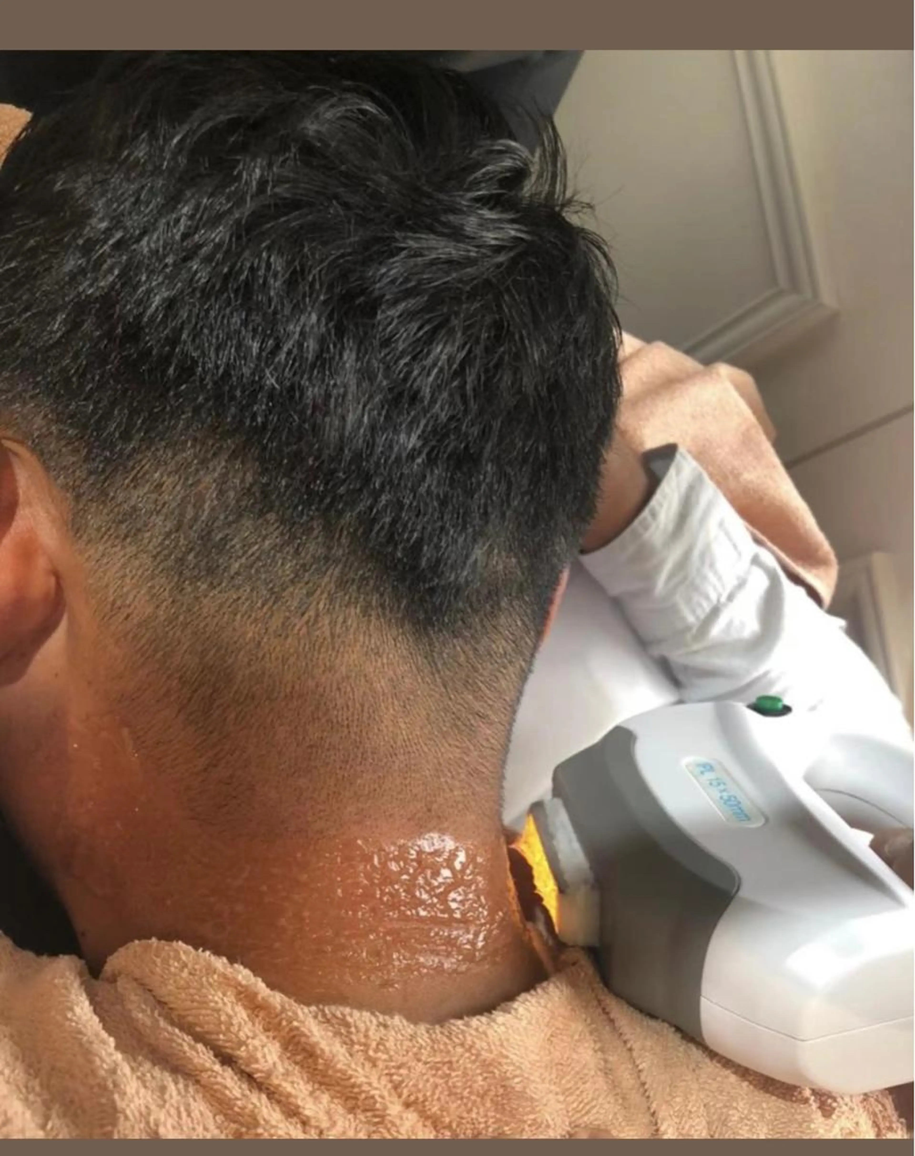 （メンズ）全身脱毛（＋VIO）3回券★40%OFFでさらに実質1回無料★  期限3ヶ月　回数　3回の写真