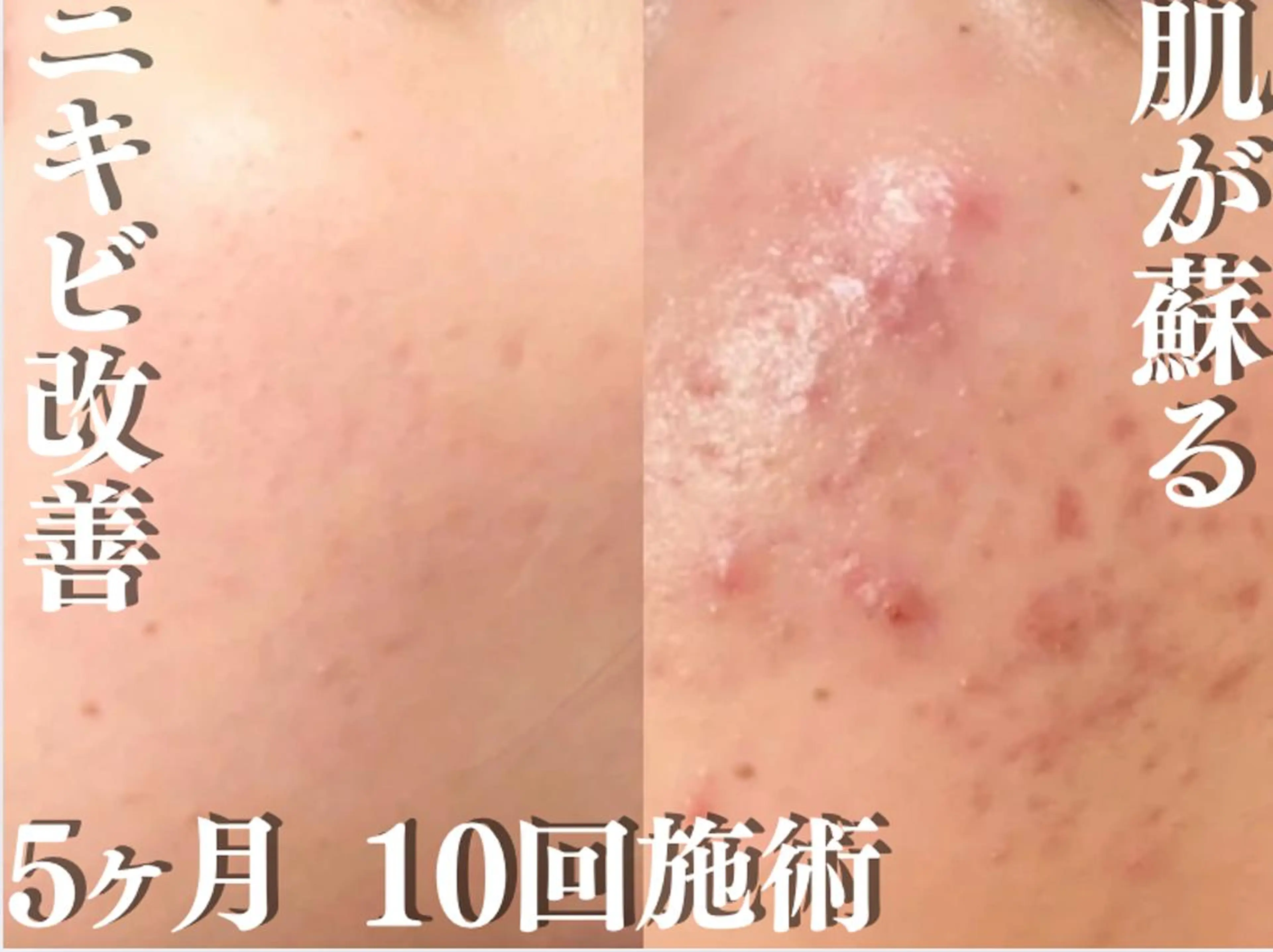 ニキビ経験者が施術 する専門サロン🌻のエステ・リラクイメージ