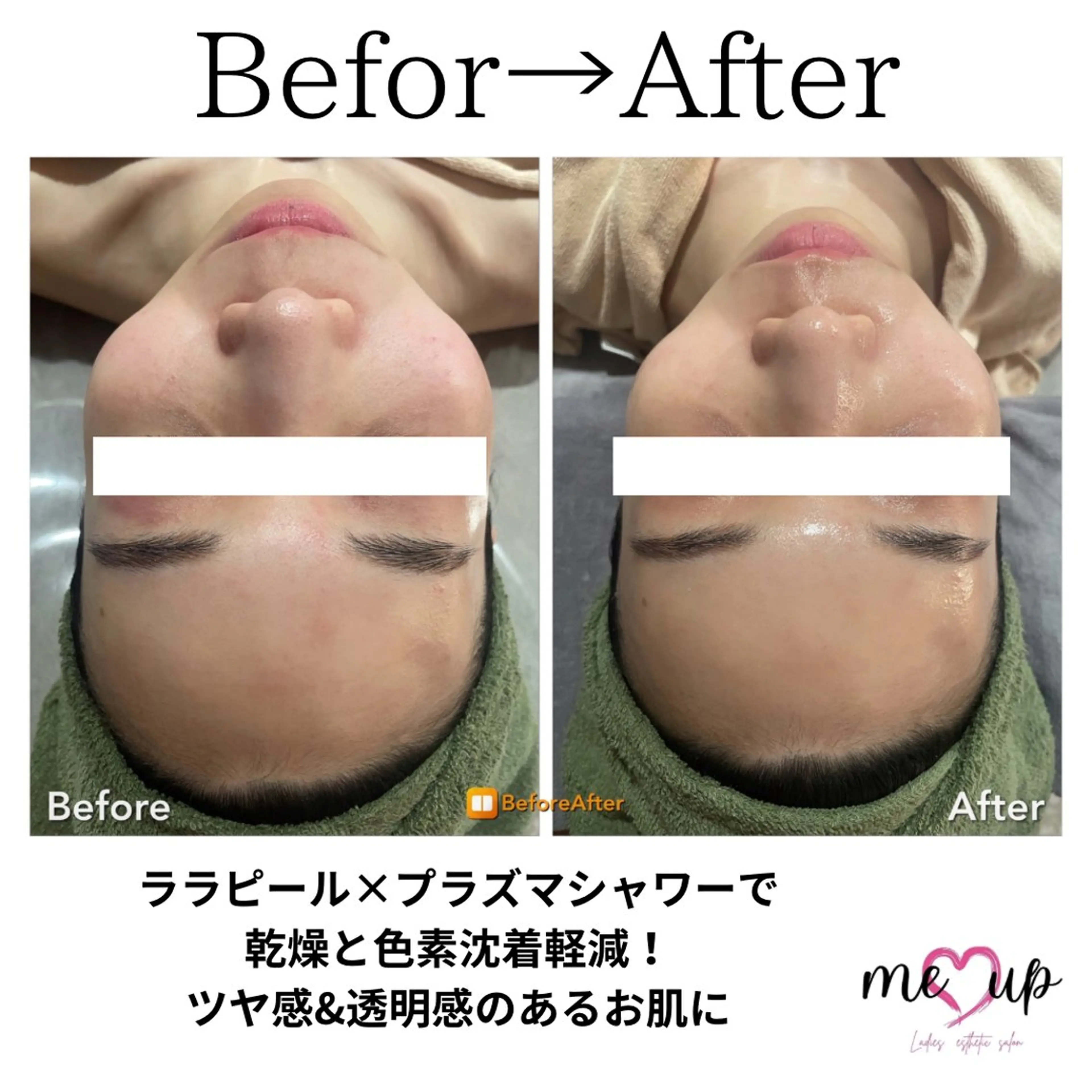 エステ Meupニキビ専門店 背中/ハーブ/肌管理のその他イメージ