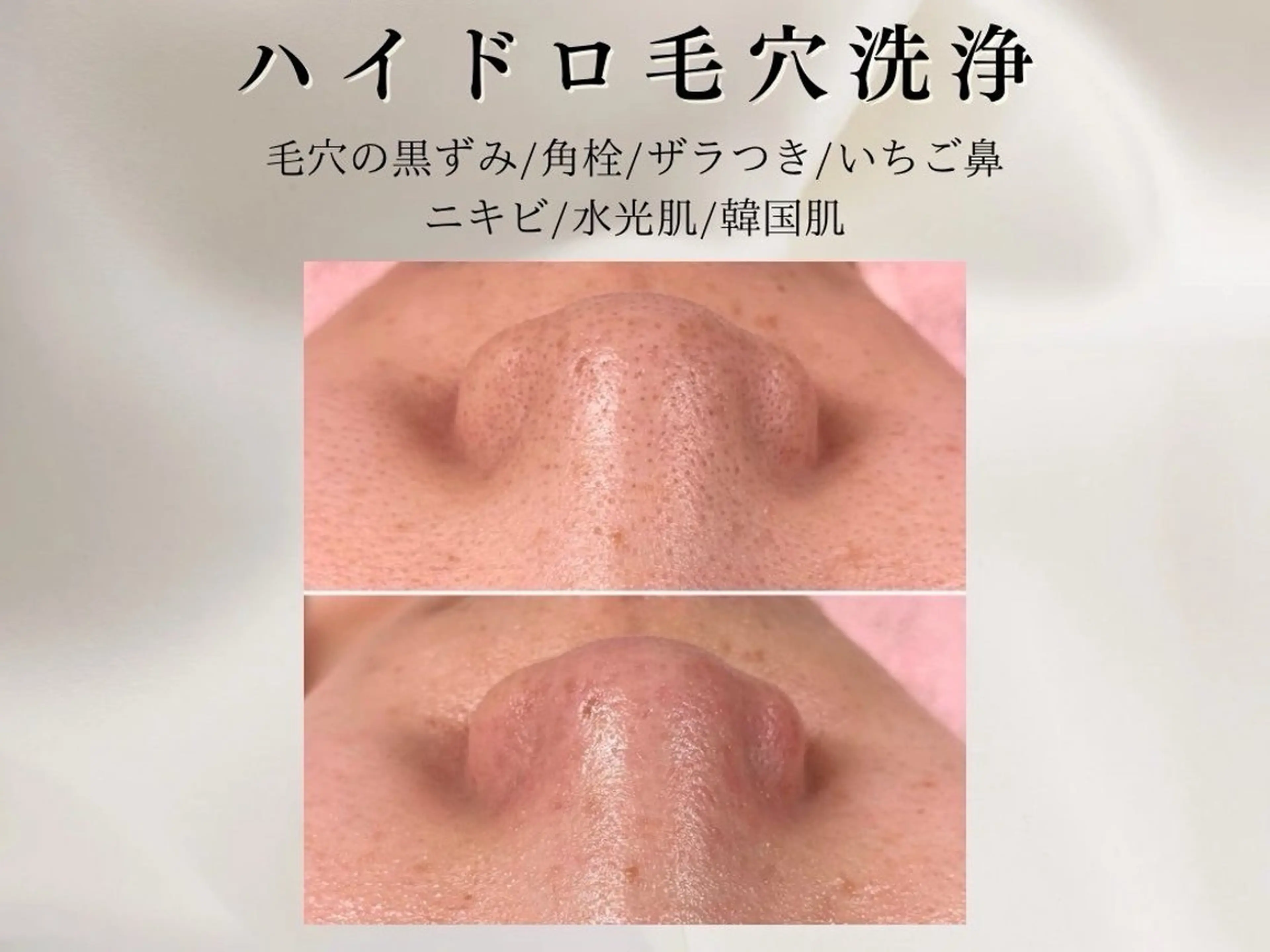 毛穴洗浄◇ハイドロフェイシャル【白玉艶肌パック仕上げ/美白】の写真