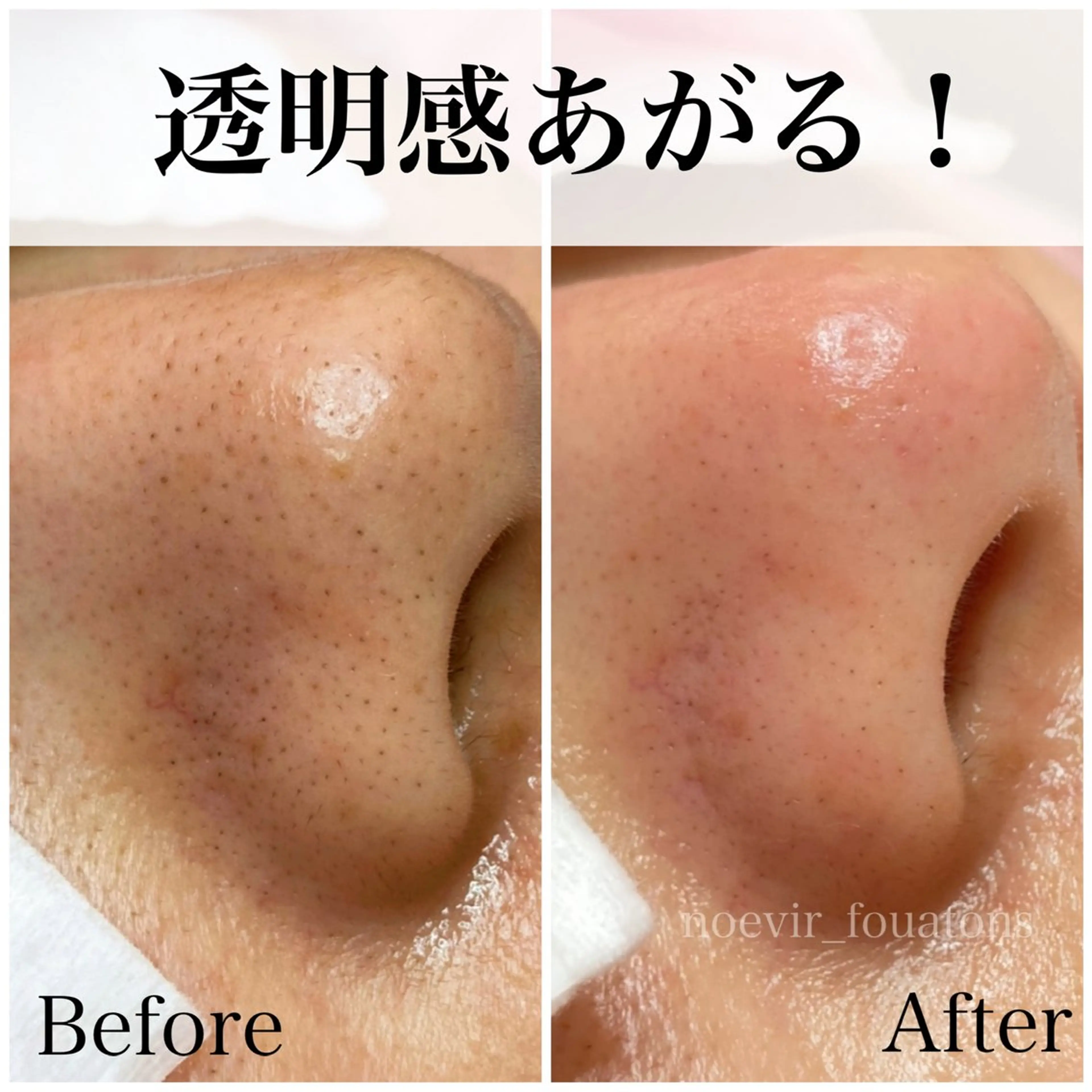 2回目からこちら💁♀️💕【毛穴エクストラクション】70分¥7,400の写真