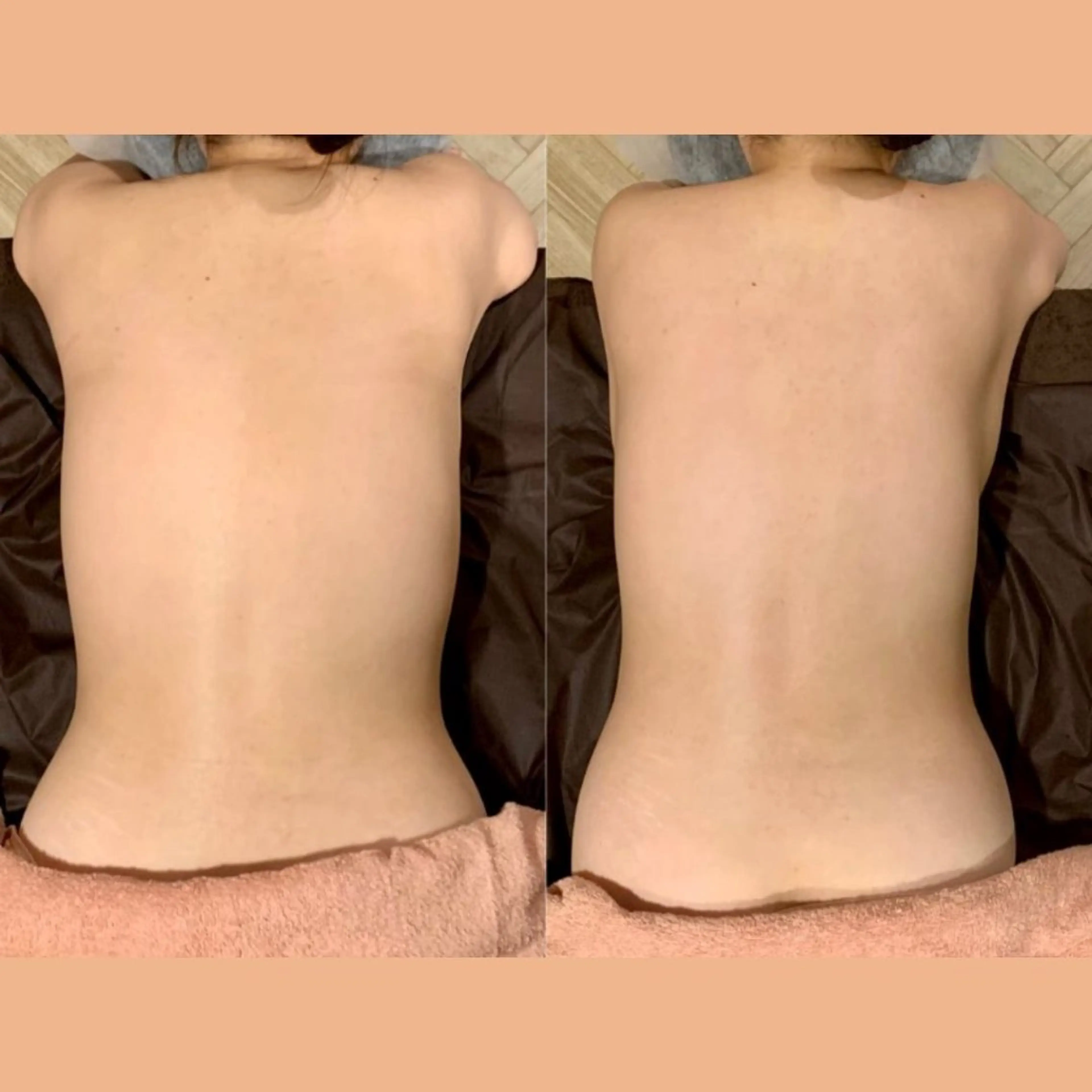 【ミニモ限定‼️】背中40分コースの写真