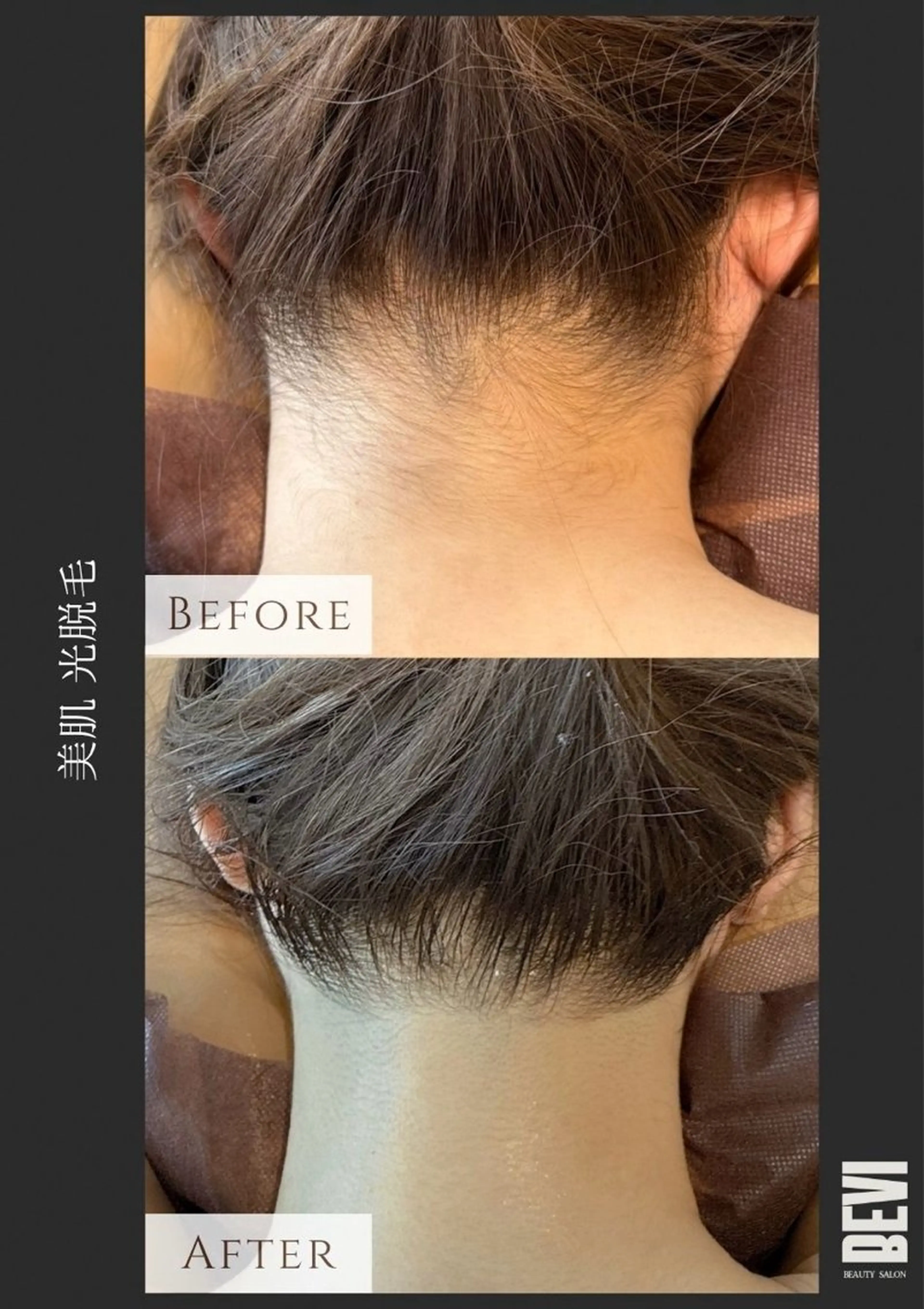 脱毛 Bevi salonのその他イメージ