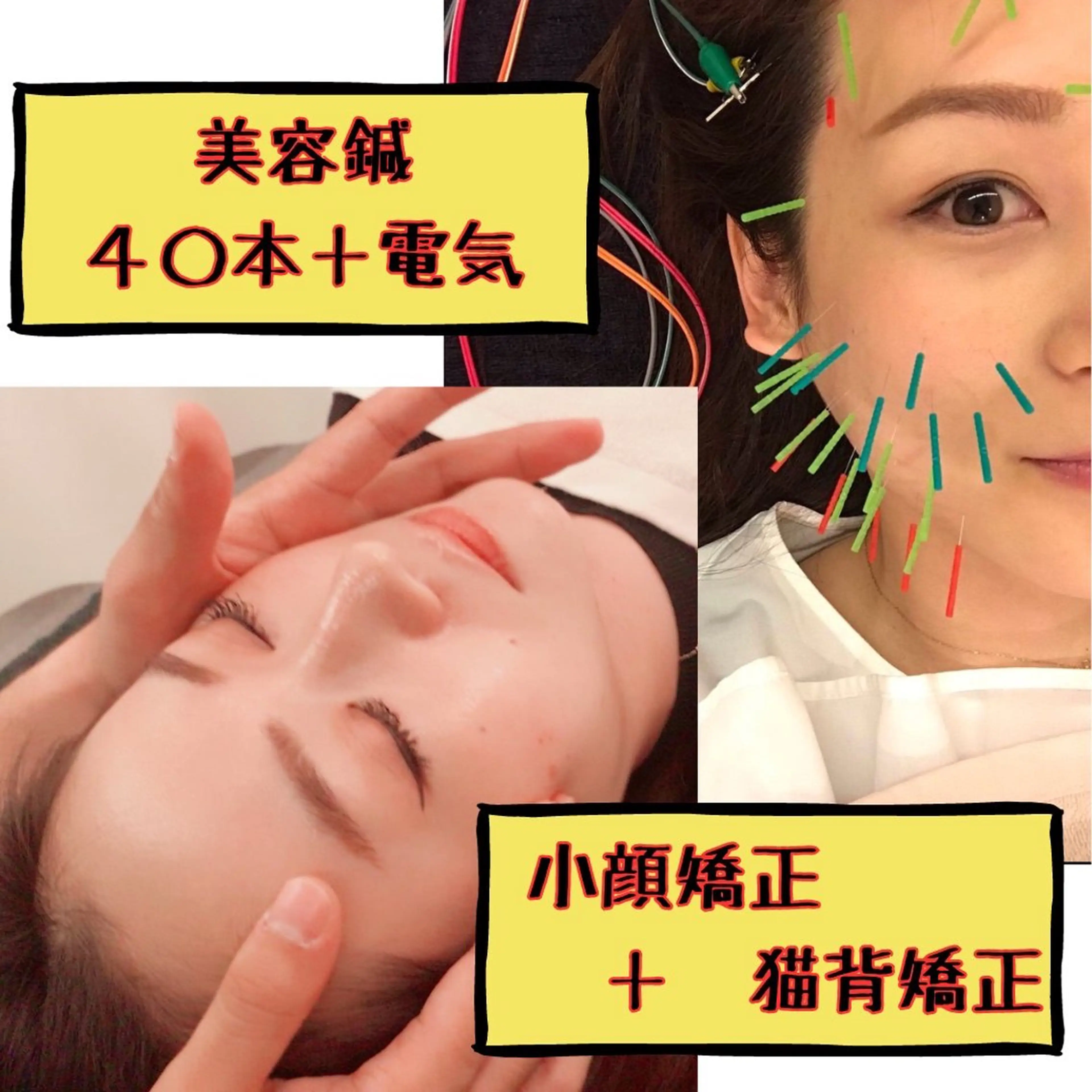 【40本使用】美容鍼＋小顔矯正+猫背矯正🌟スタンダードコースの写真