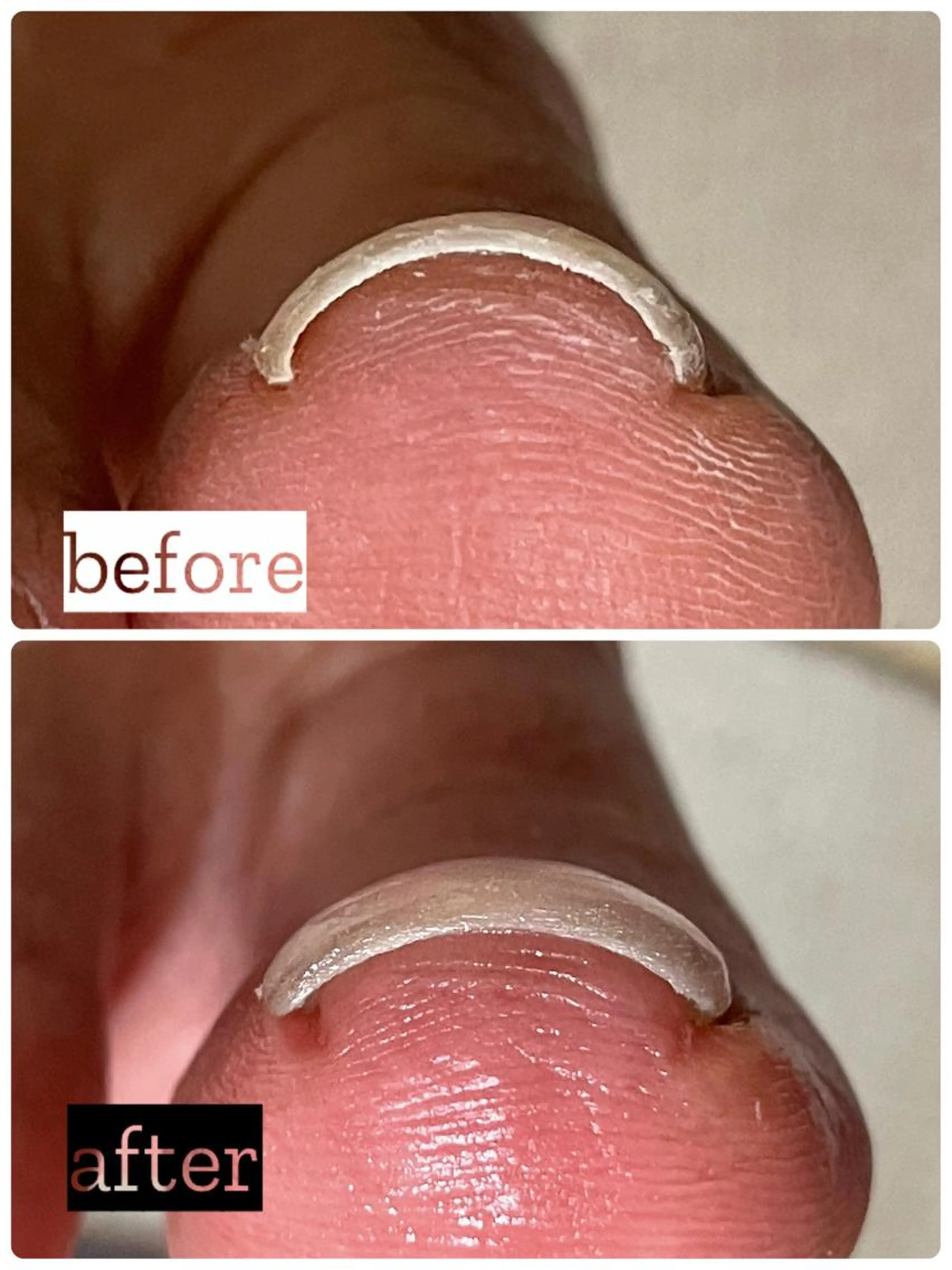 限定→残り2名(10名募集)‼️痛みとさよなら👋🏻足爪のトラブル巻き爪•陥入爪•変形爪•肥厚爪•たこ 詳細へ↓の写真