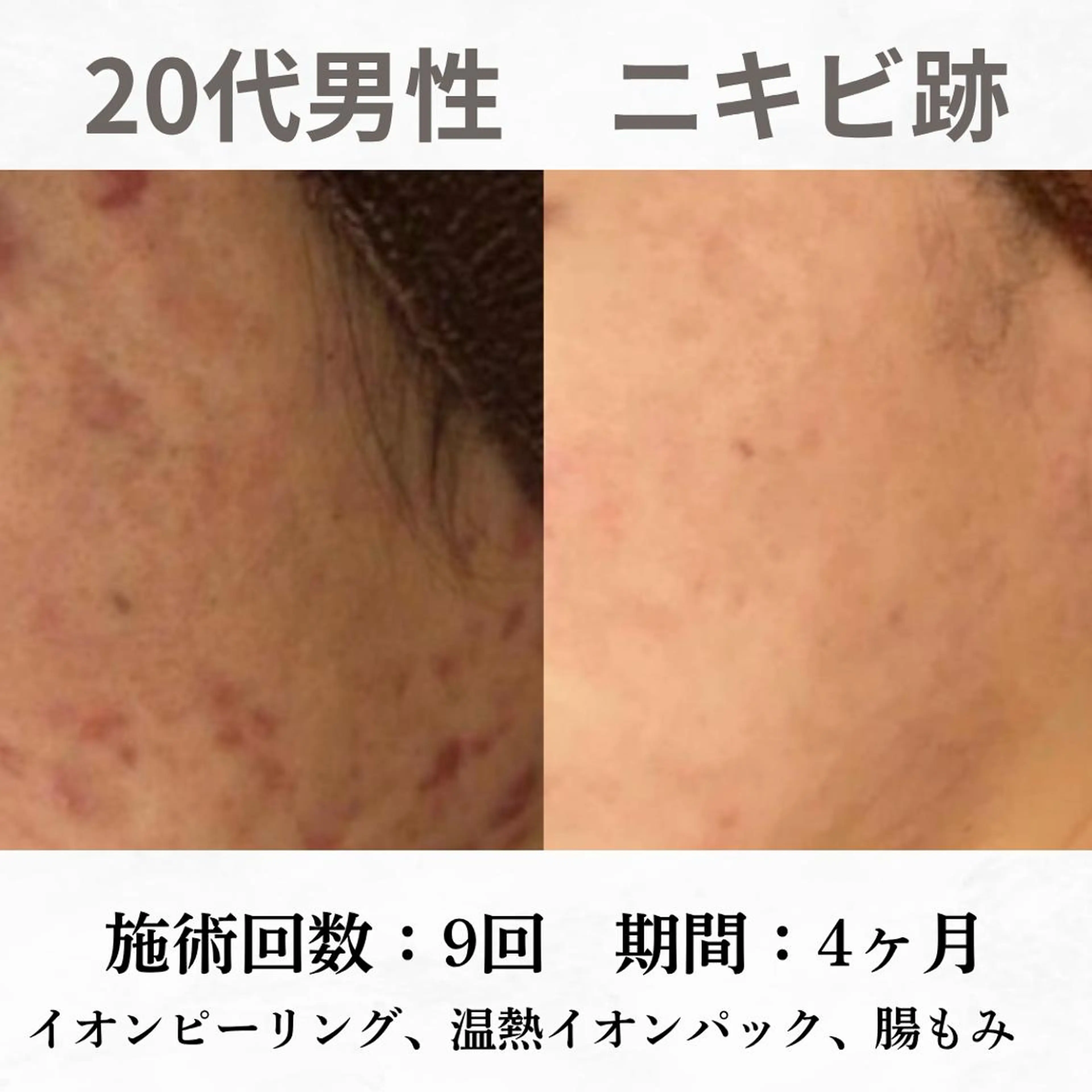 重度ニキビ専門🌷 ダウンタイムなしのエステ・リラクイメージ