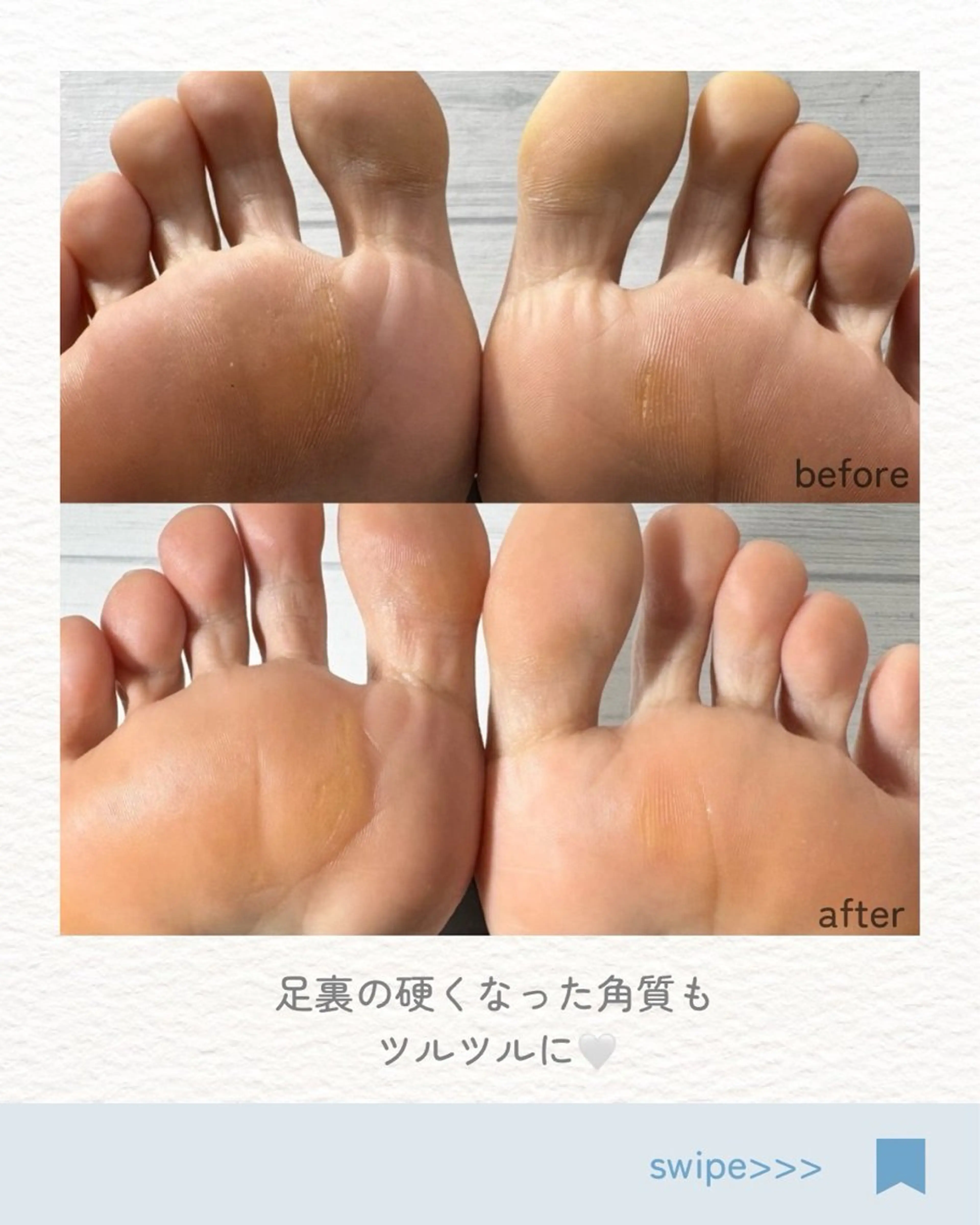フット角質ケアの写真