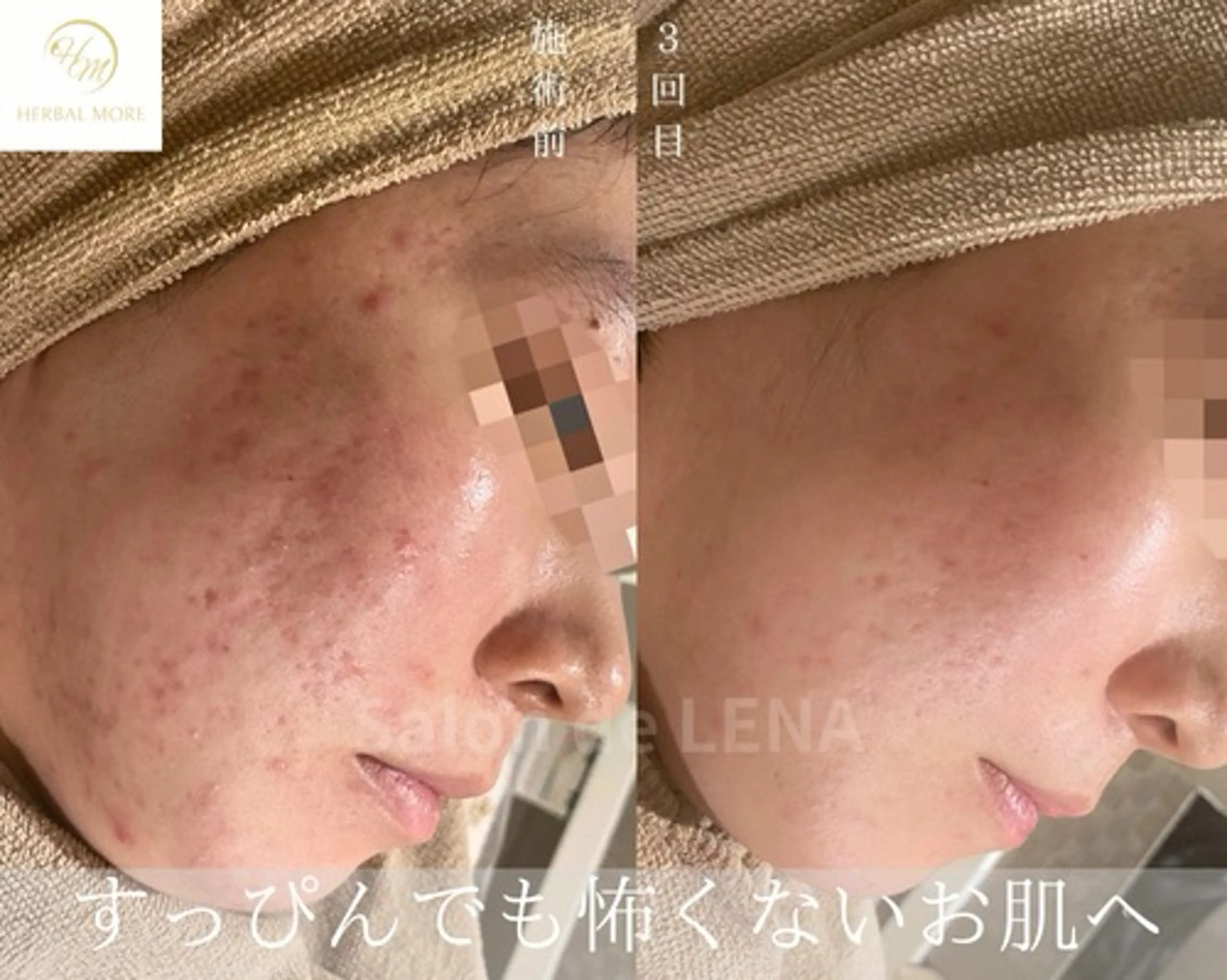 ハーブピーリング・毛穴ケア専門サロンSalon de LENA 栄店所属・ハーブピーリング専門 サロンドレナ　白藤のエステ・リラクイメージ