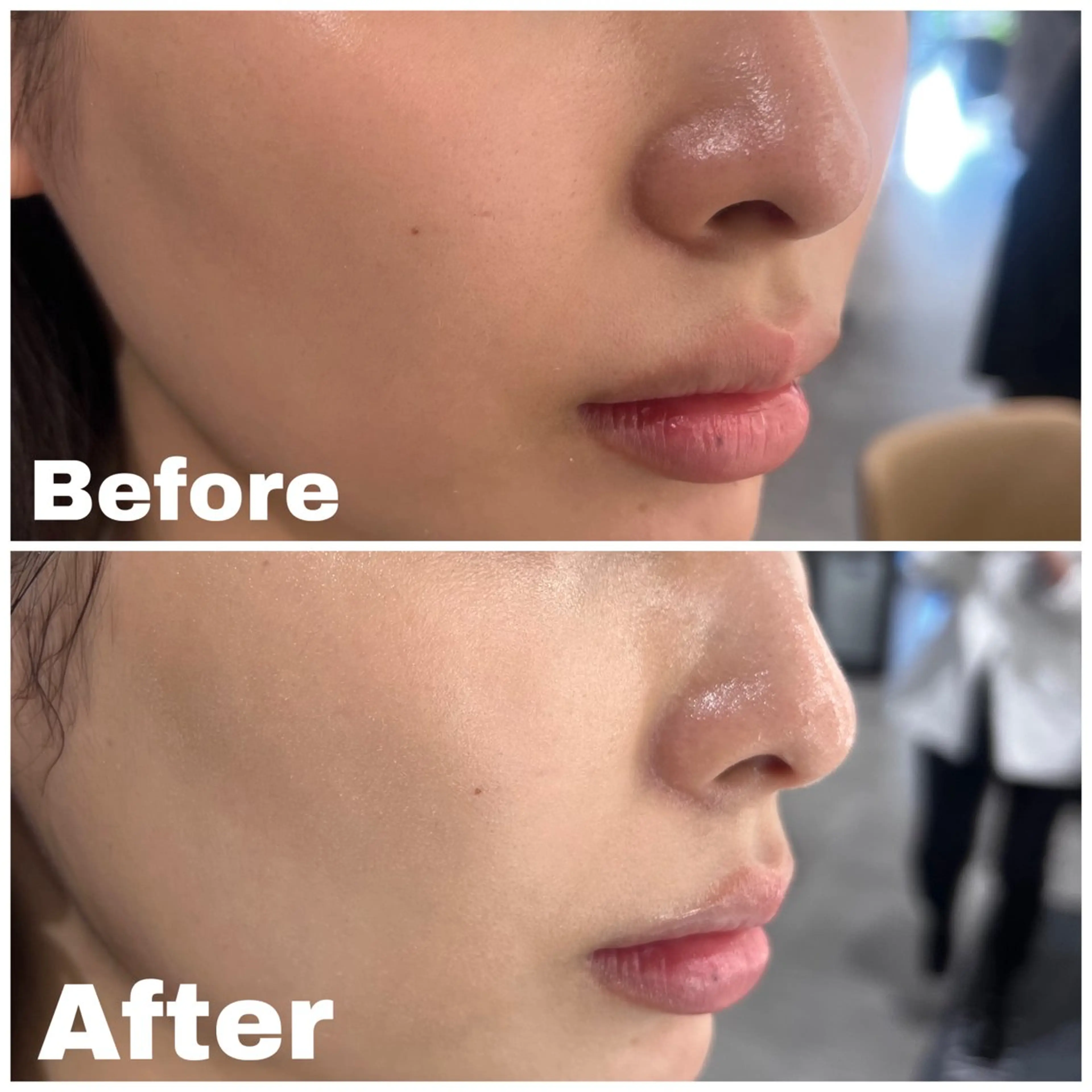 毛穴ケアコースの写真