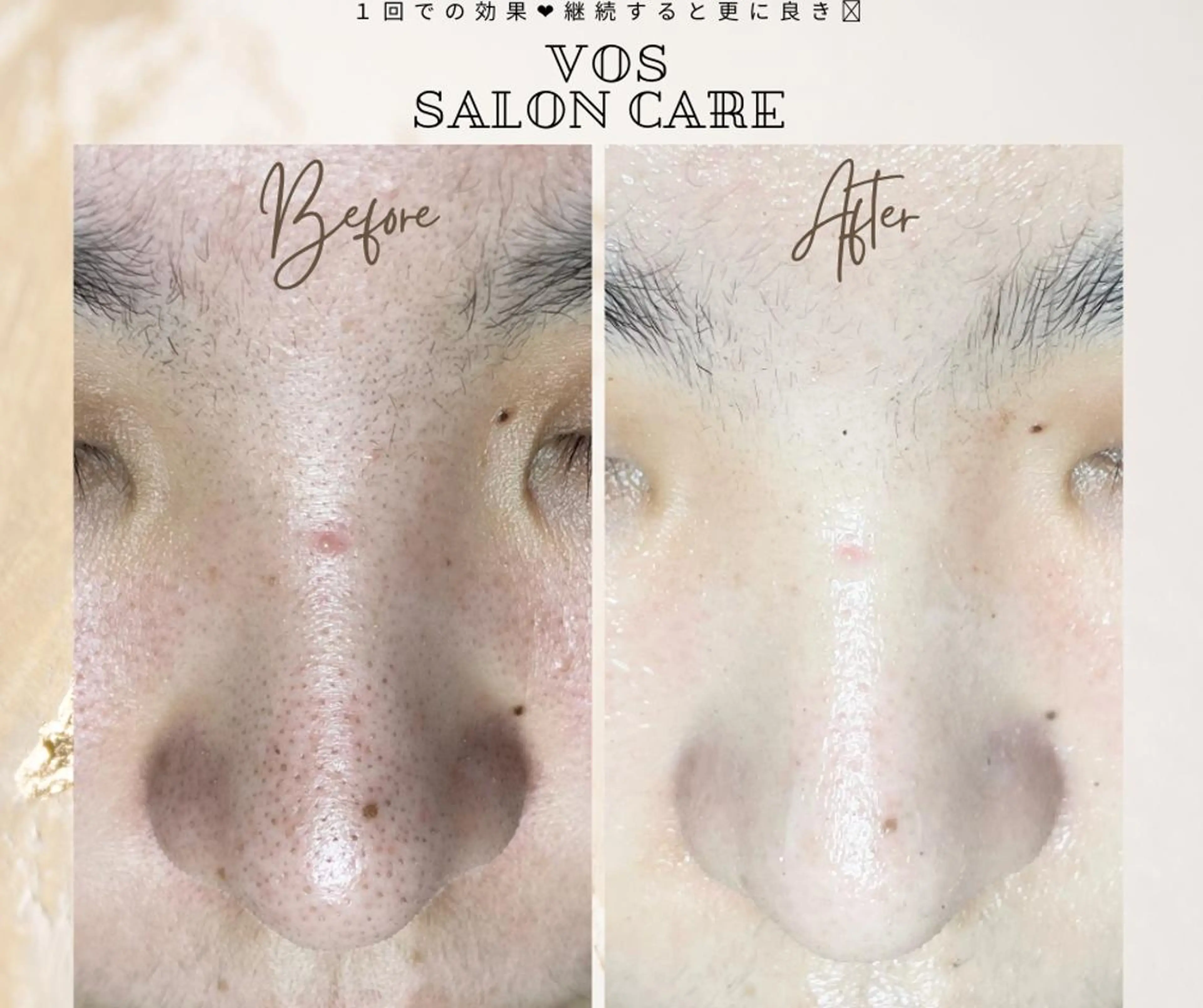 【お肌管理】フェイシャルワックス＋vosお肌質改善トリートメントの写真