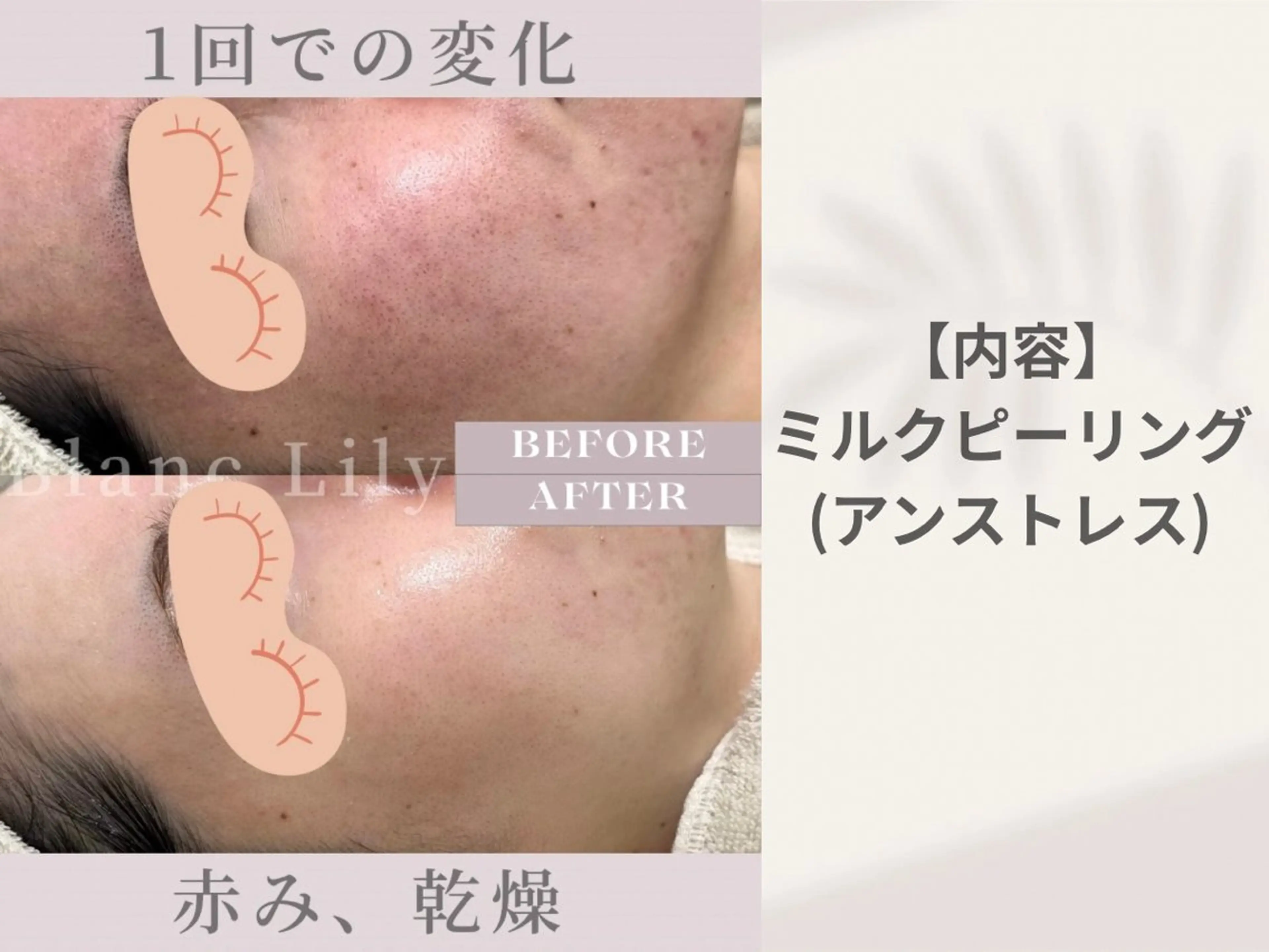 エステ ピーリング専門サロン サロンブランリリーのエステ・リラクイメージ