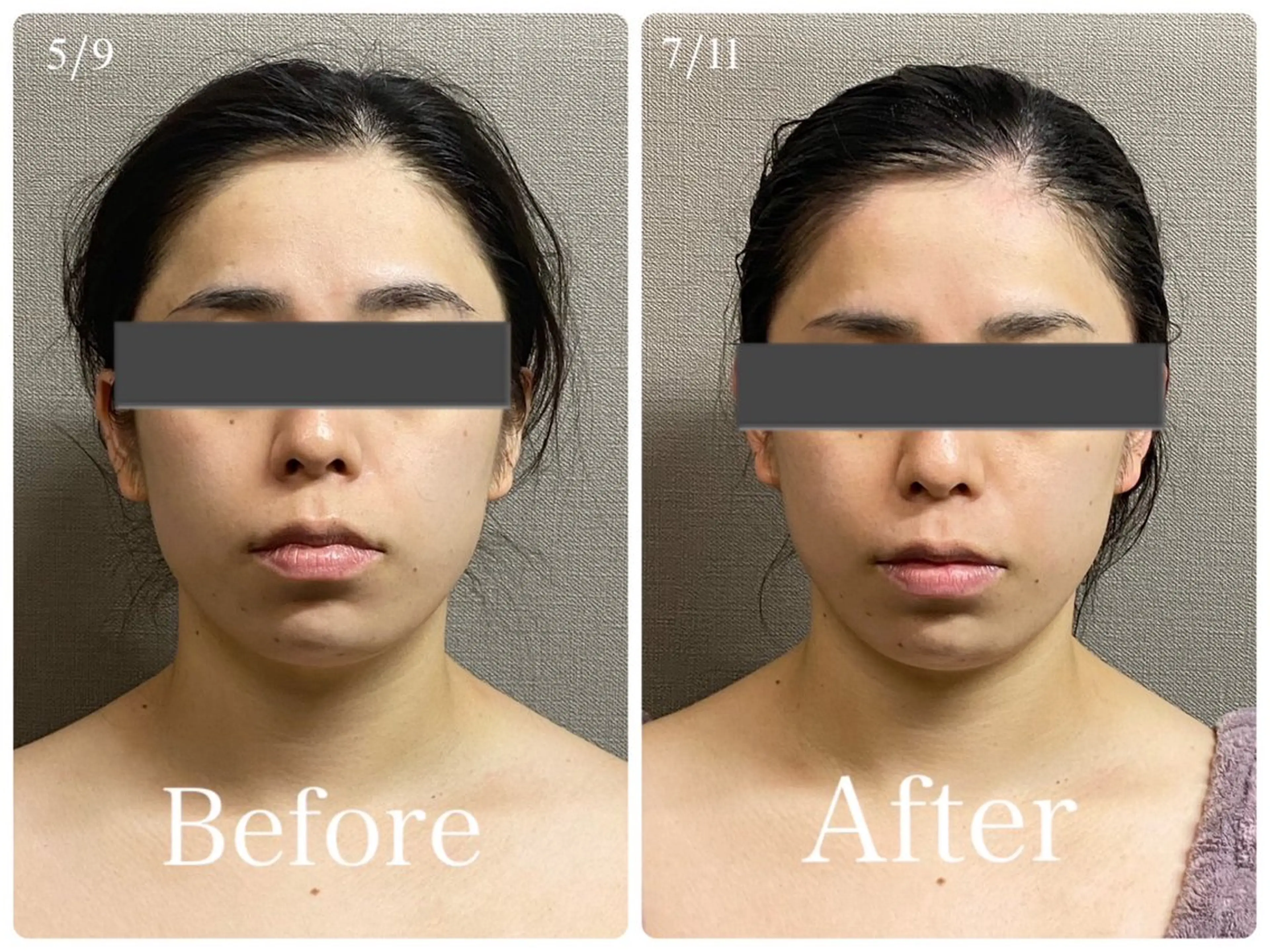 通常価格【マリオネット】筋膜リリース×美顔器＝小顔・造顔★60min【¥13200→¥6600】の写真