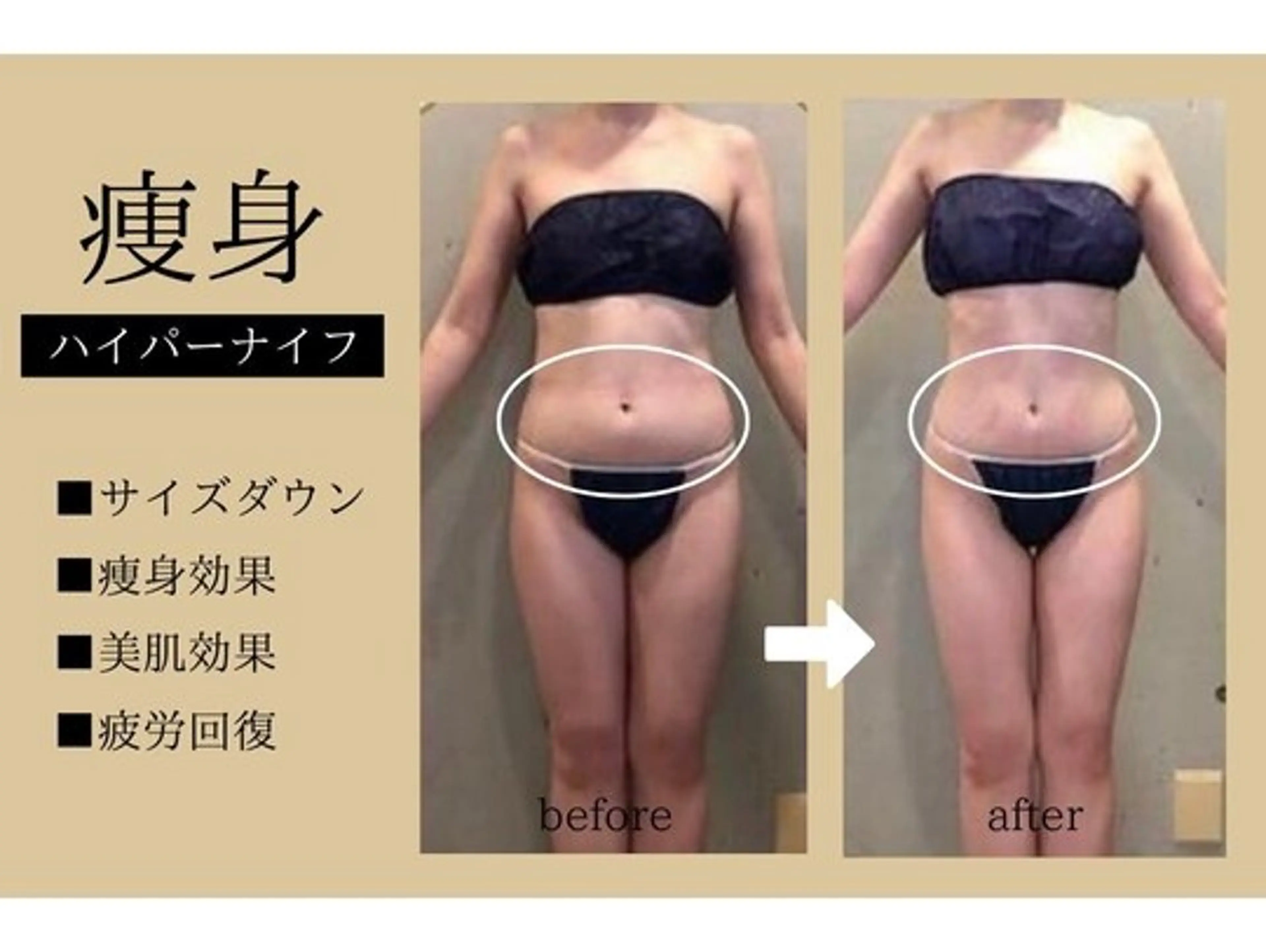 《お腹二の腕背中》ハイパーナイフ+マッサージ６０分￥9000→3500の写真