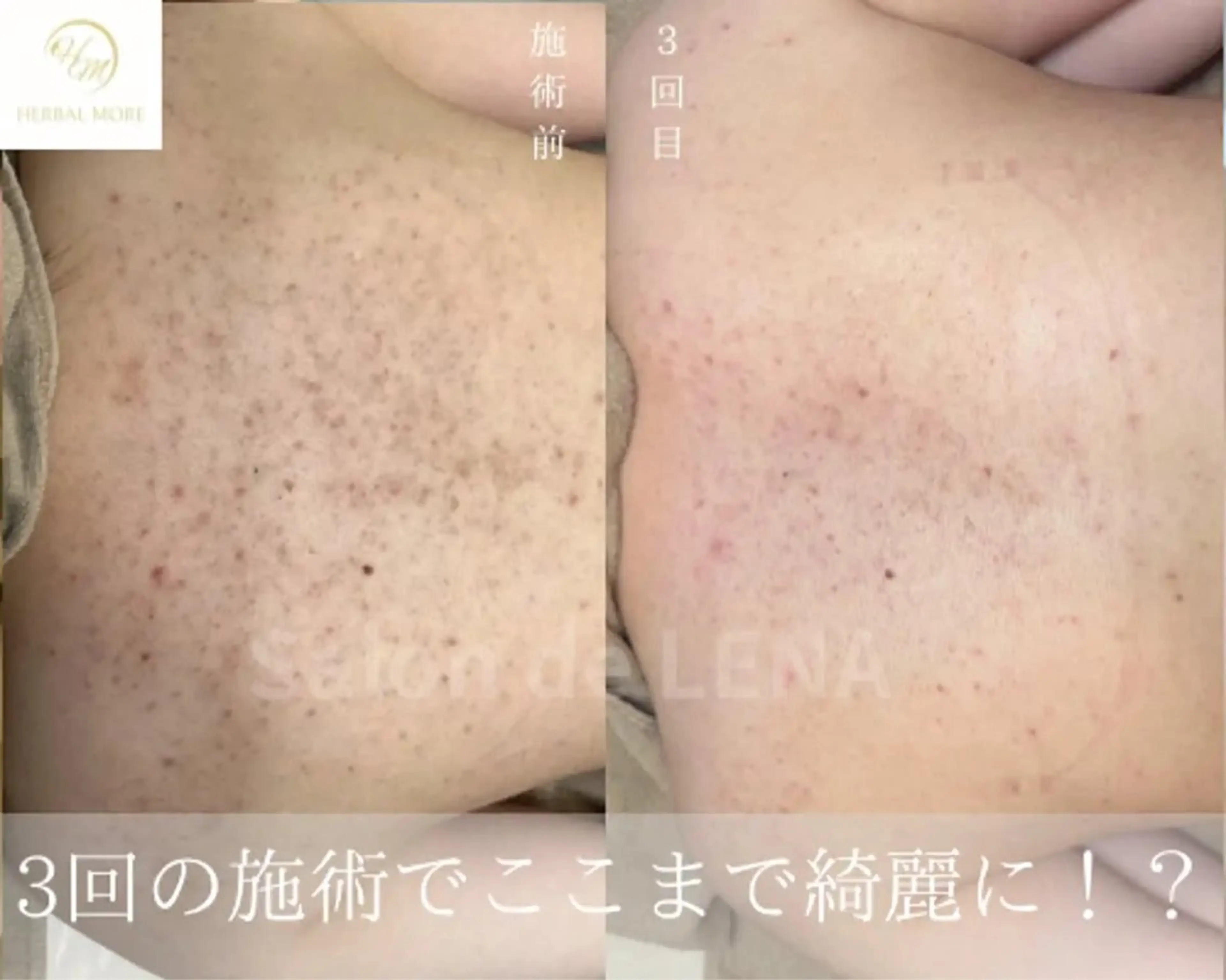 ハーブピーリング専門 グランディール　武内のエステ・リラクイメージ