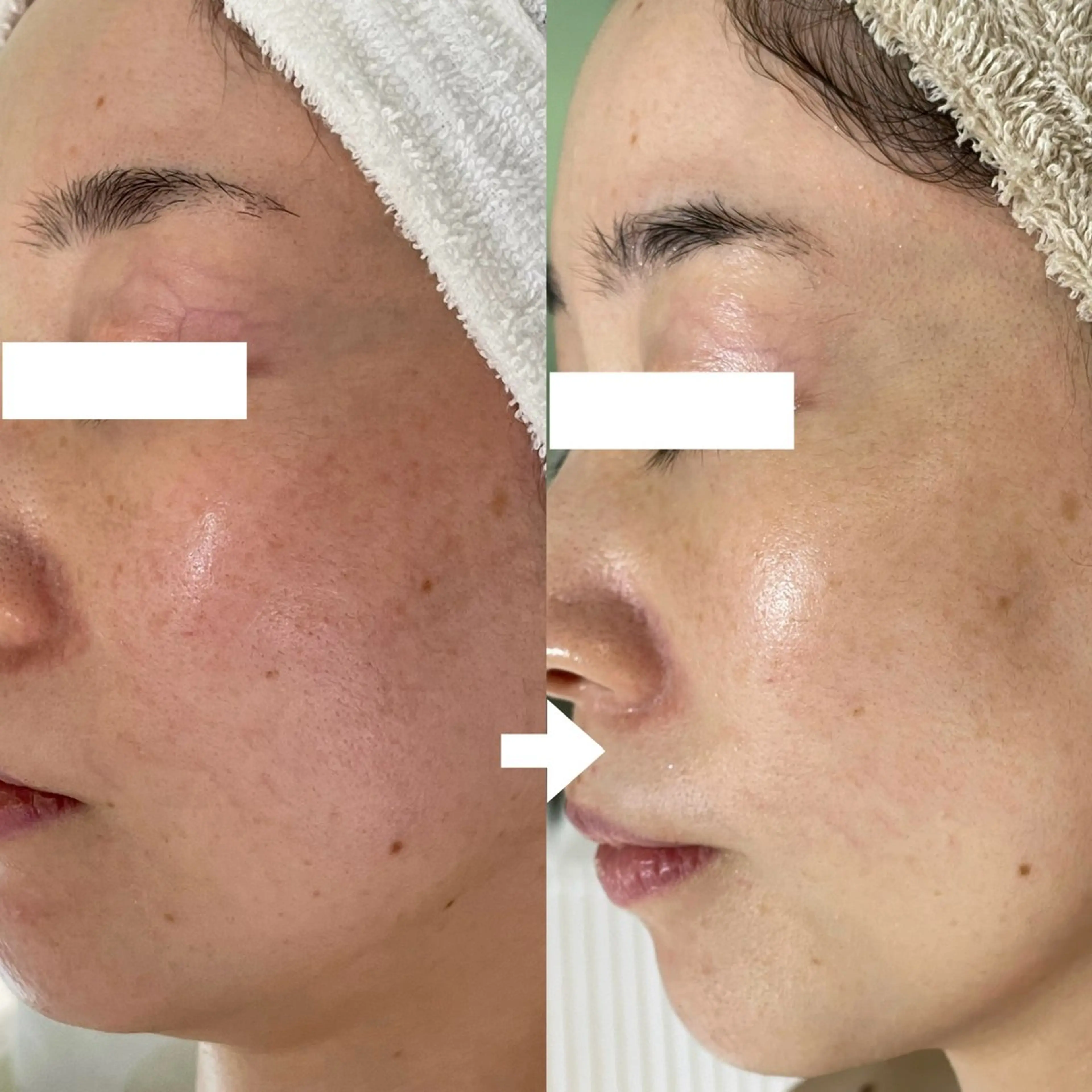 ニキビ・毛穴・ フェイシャル専門店のエステ・リラクイメージ