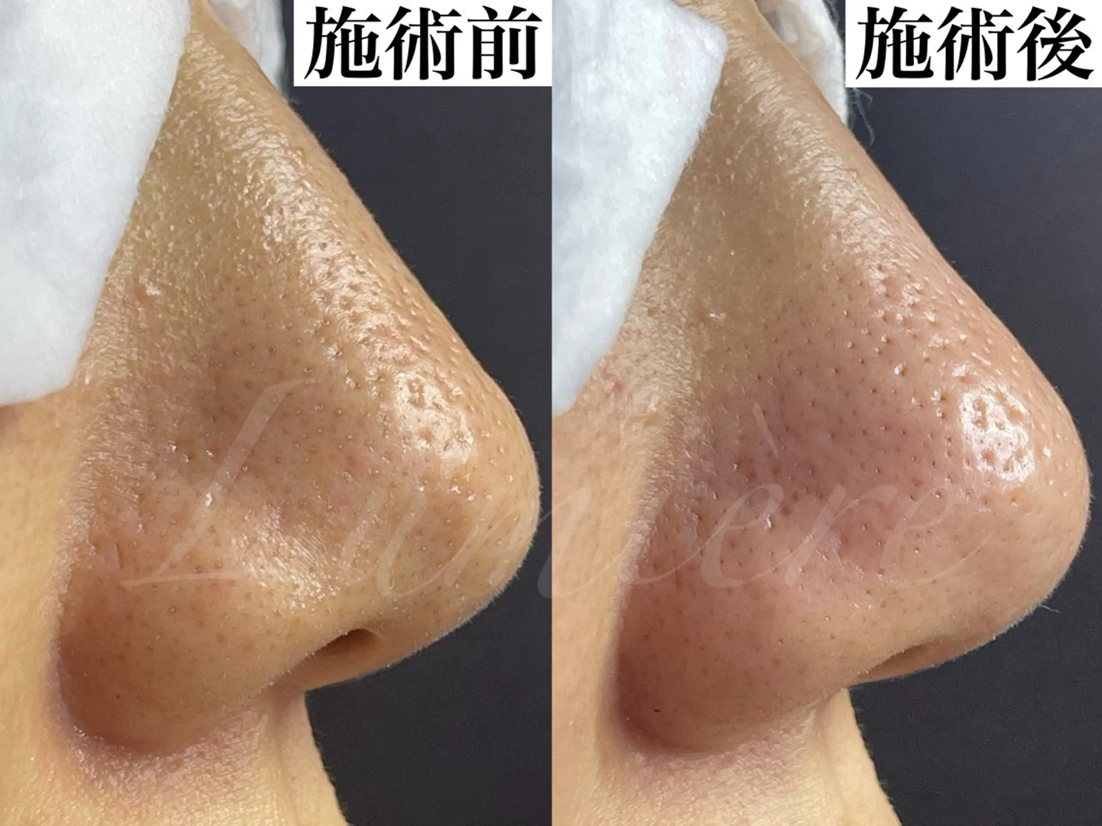 【黒ずみ＆角栓オフ】ご新規様限定✨毛穴徹底ケア❣️その場で作る生パック＋極上ヘッドマッサージ付💆‍♀️南森町駅徒歩5分の写真