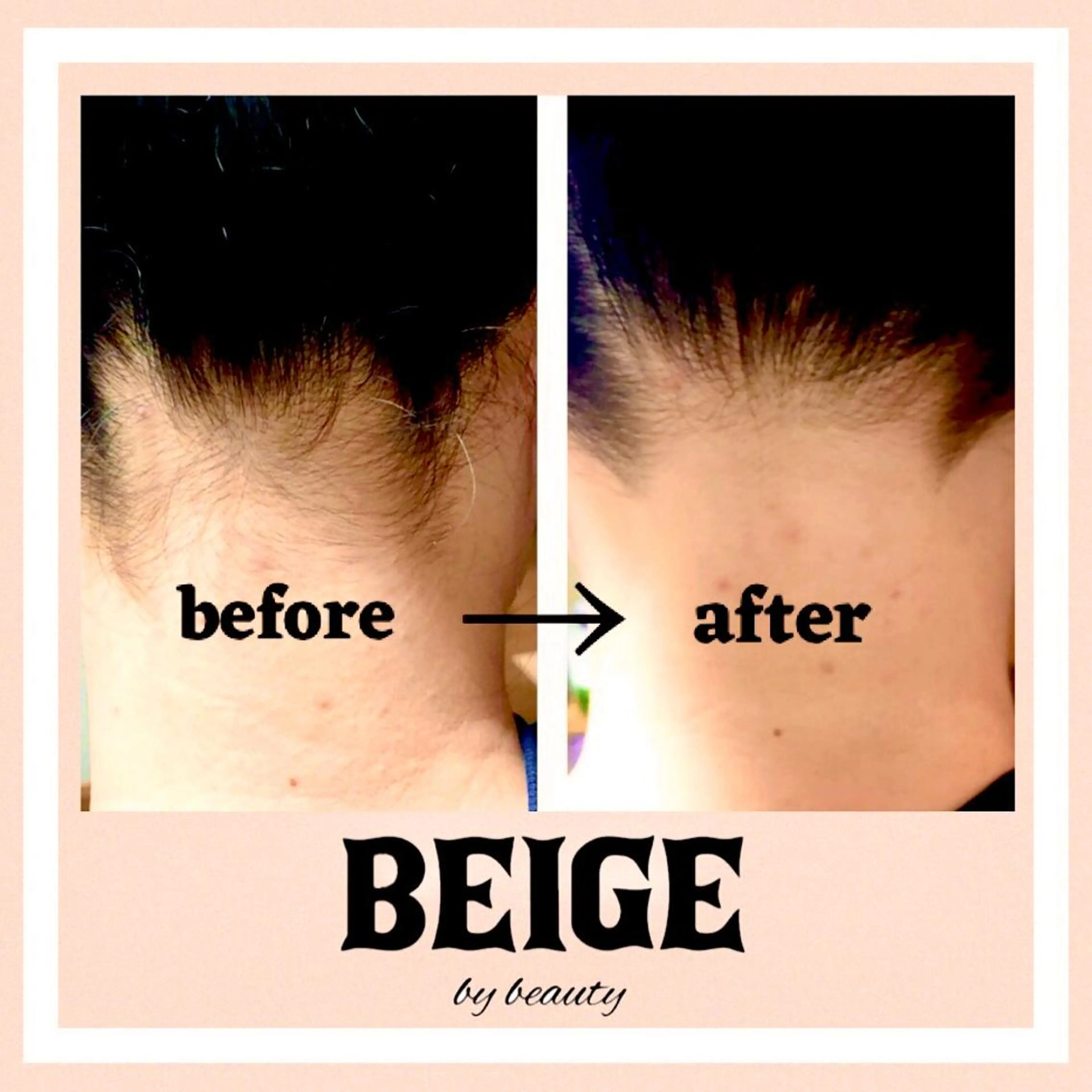 後ろ姿目綺麗に☆...うなじ脱毛 プラセンタケア付¥3,450の写真