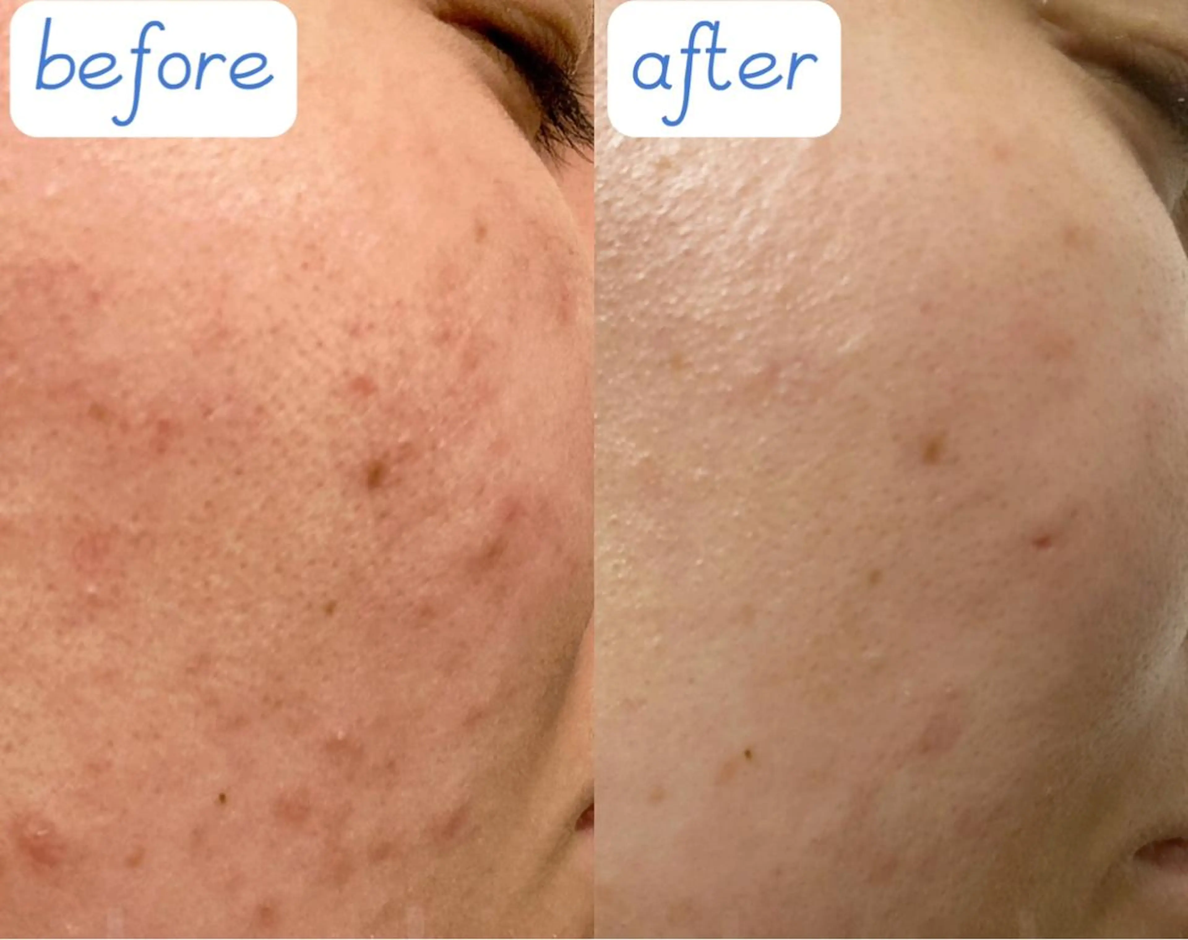 小顔/毛穴/ニキビ salon bealのエステ・リラクイメージ