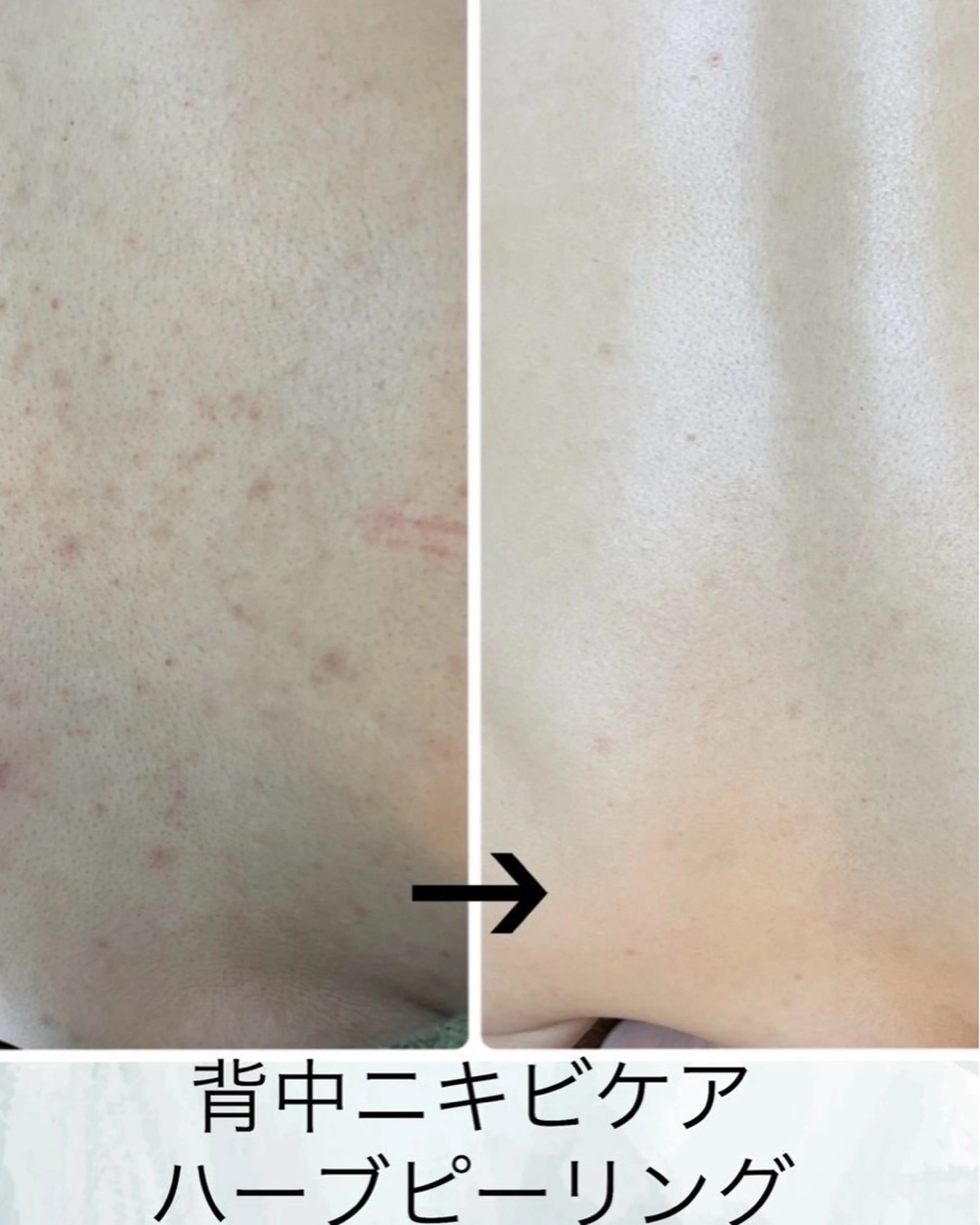 エステ ハーブピーリング　美肌サロン　health and beauty maki所属・ハーブピーリング 美肌サロン　makiのエステ・リラクイメージ