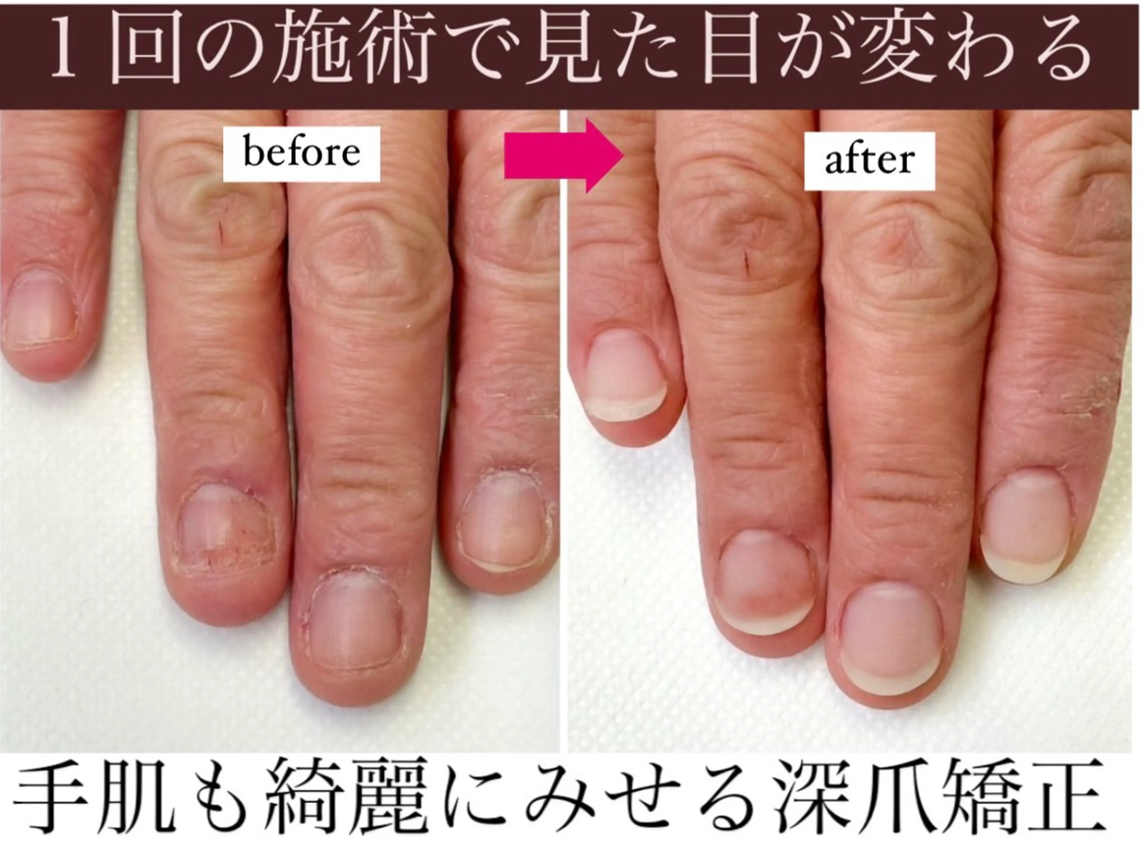 【深爪矯正★女性ハンド】お試し1回体験の写真