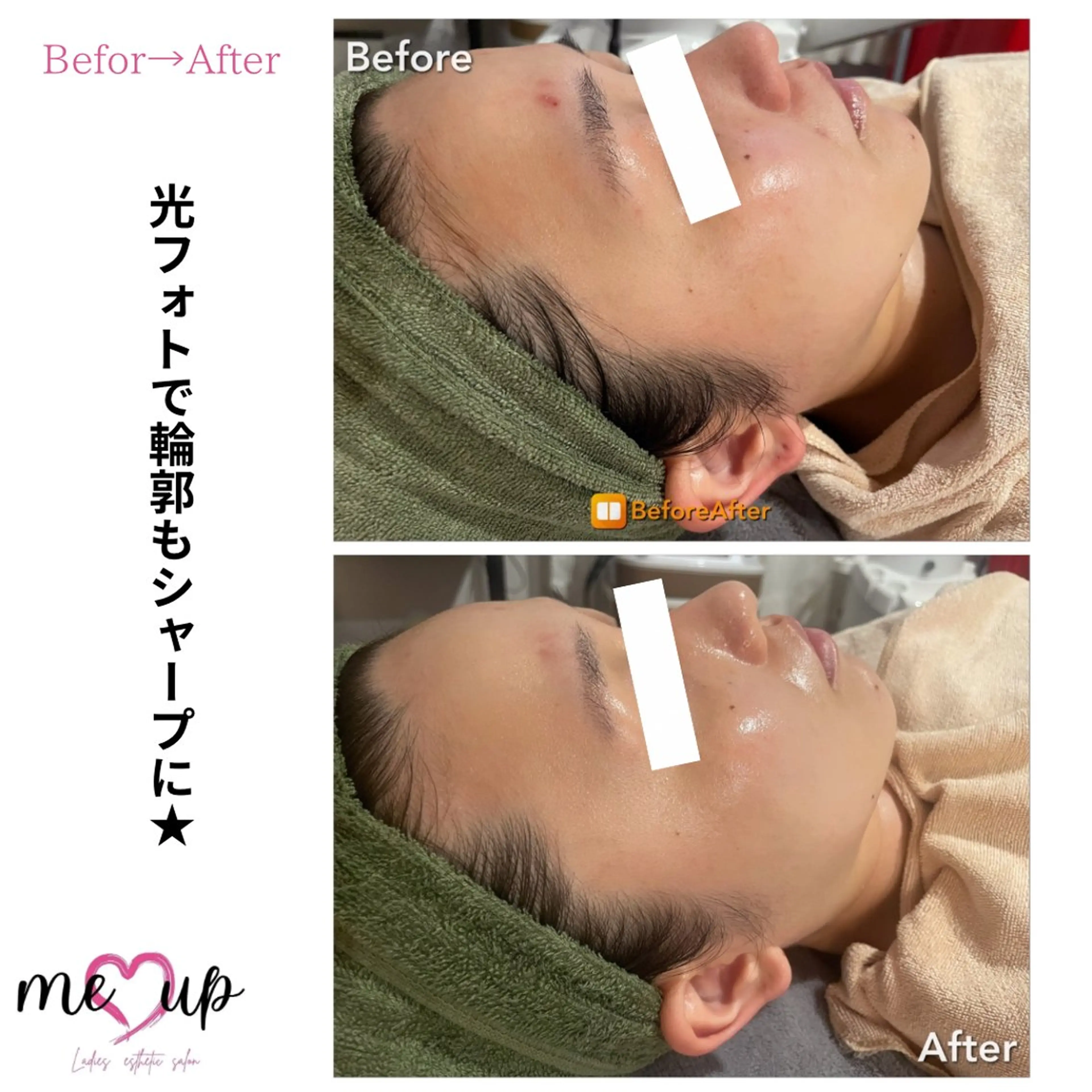 エステ Meupニキビ専門店 背中/ハーブ/肌管理のその他イメージ