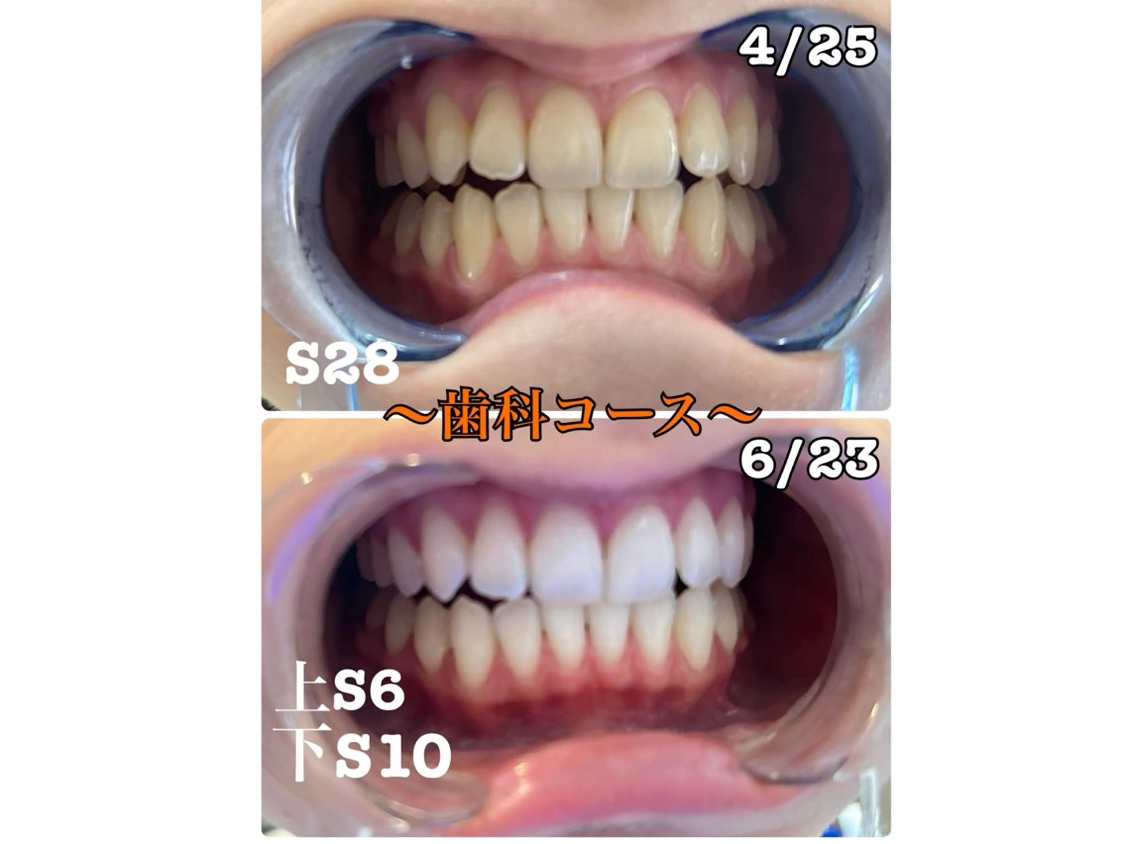 歯のセルフホワイトニング専門店GLOW(グロウ)所属・東区香椎歯のセルフホ ワイトニングGLOWのその他イメージ