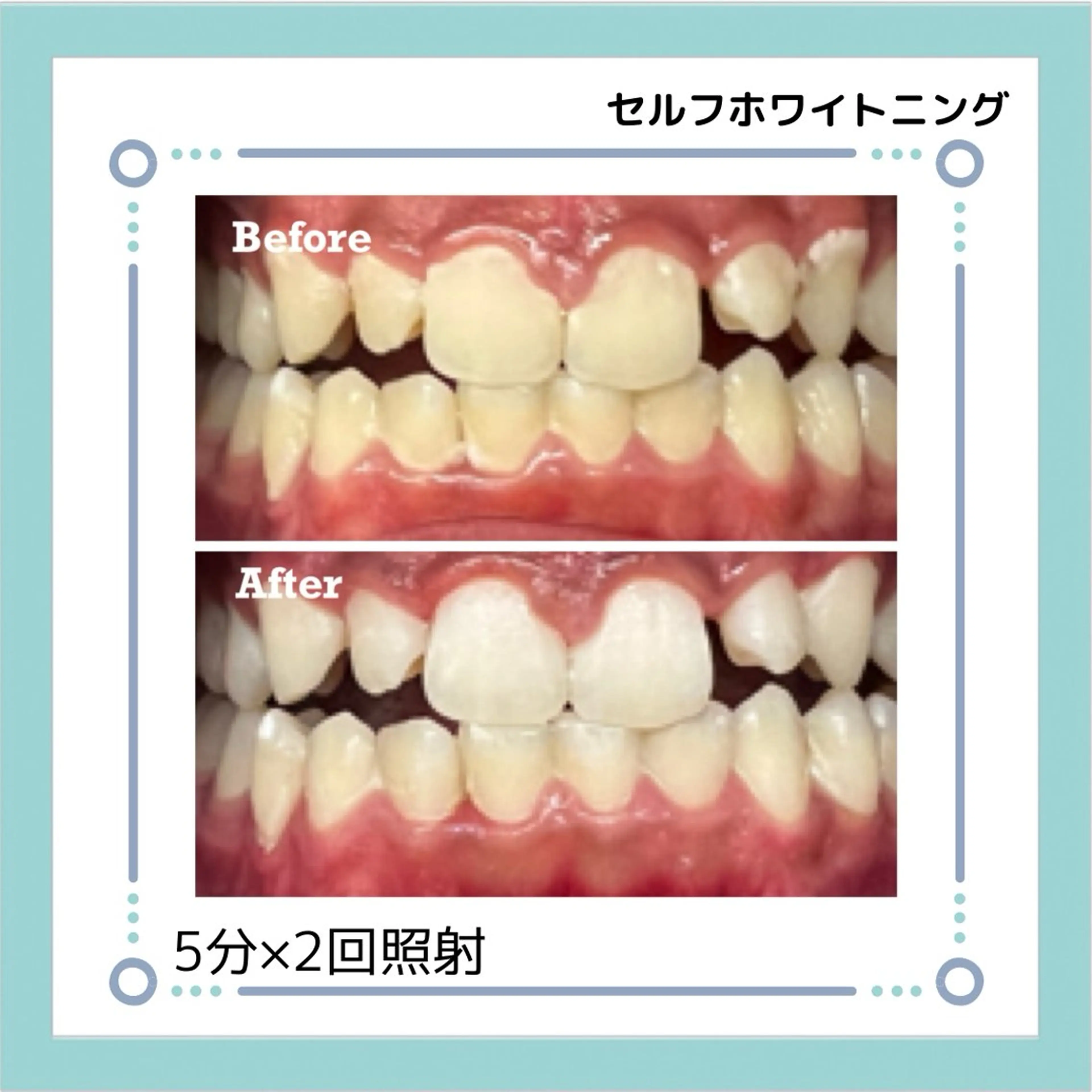 セルフホワイトニング【５分×2回照射】の写真