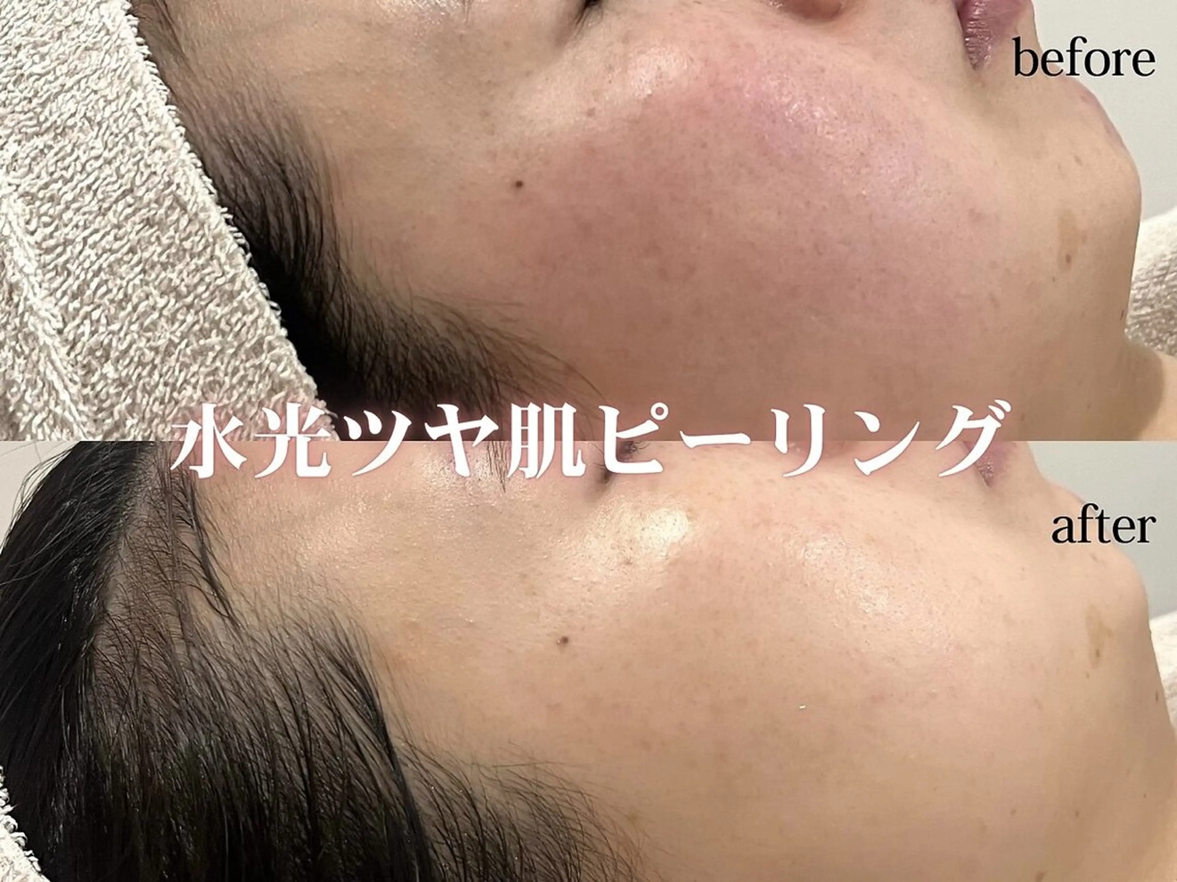 【毛穴レスピーリング】ラミネーションピール×カーボキシーの写真