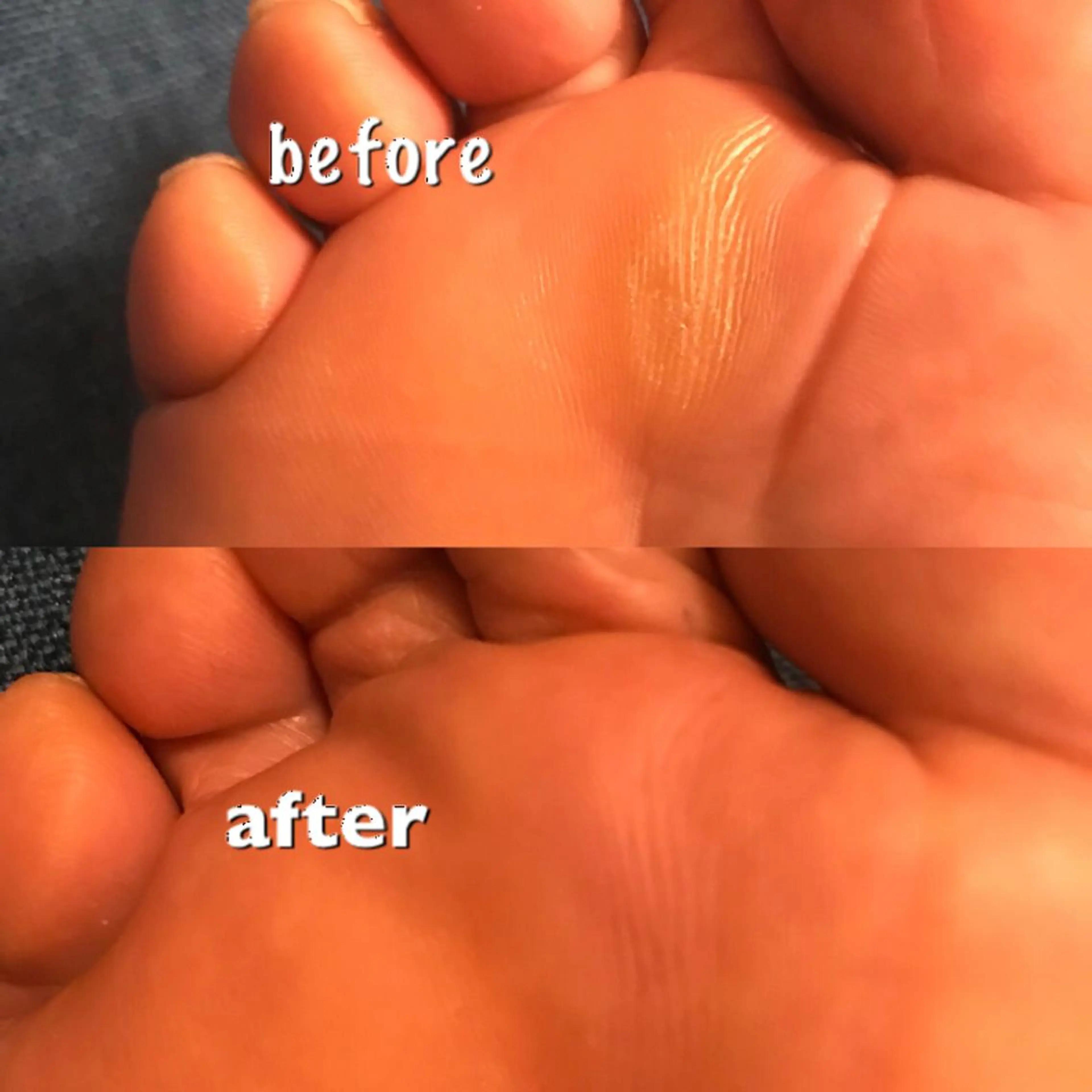 ドイツ式フットケア（魚の目、タコが気になる方）40分の写真