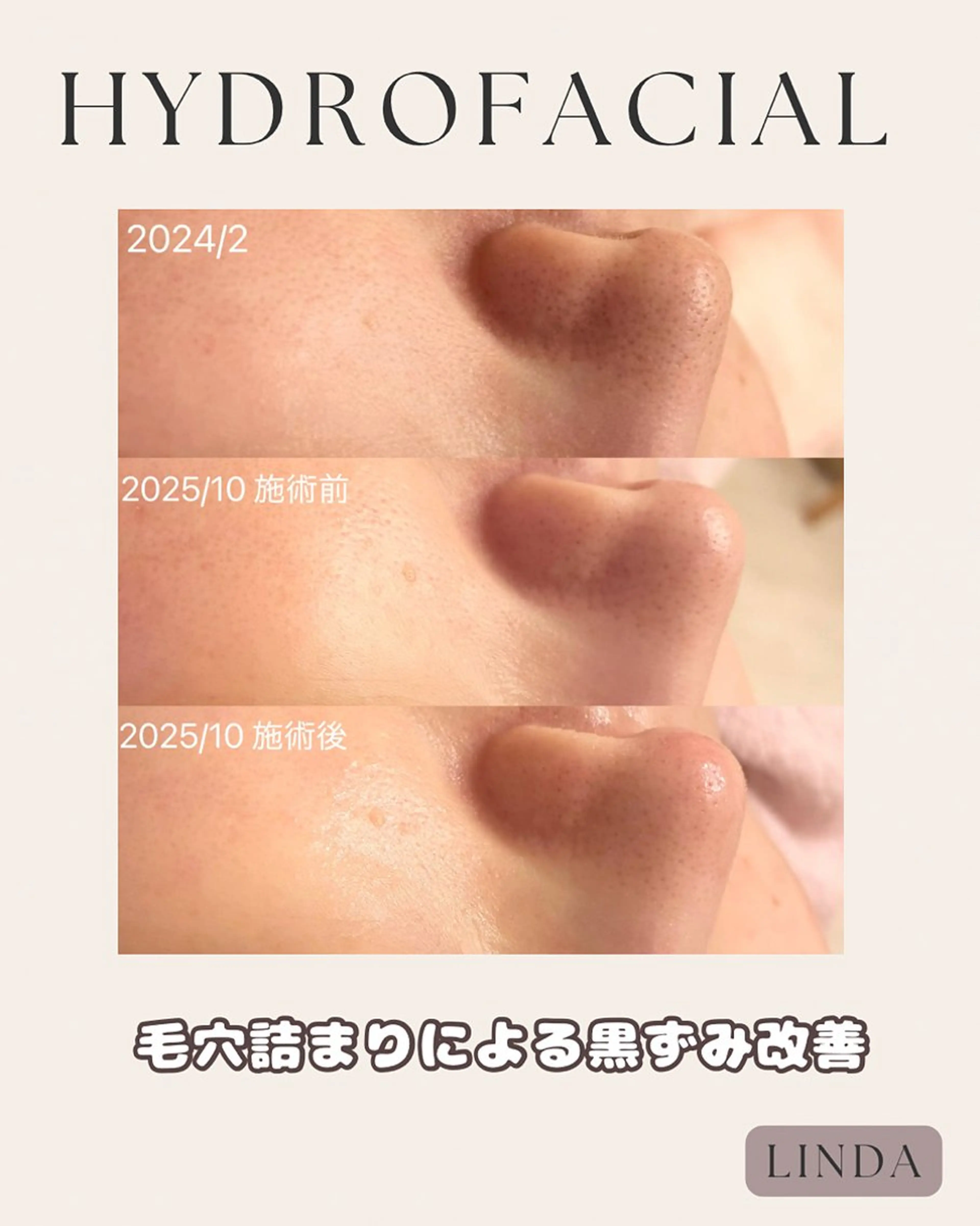 小顔&毛穴・肌質改善 LINDA西宮 AIのその他イメージ