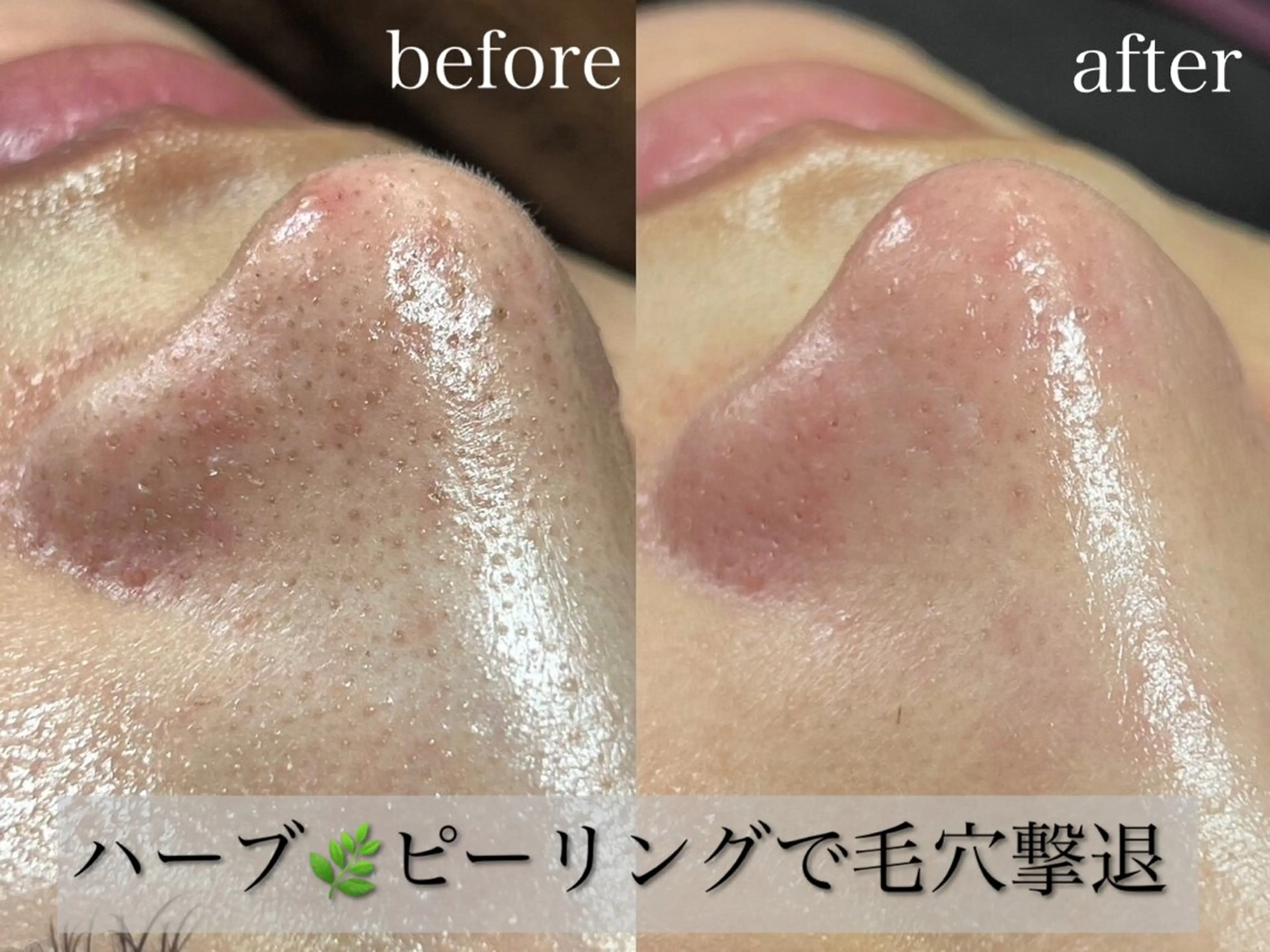 人気No.1🌿ハーブピーリング🌿【毛穴/黒ずみ/ニキビケア】スーパーデトックス　¥5,660の写真