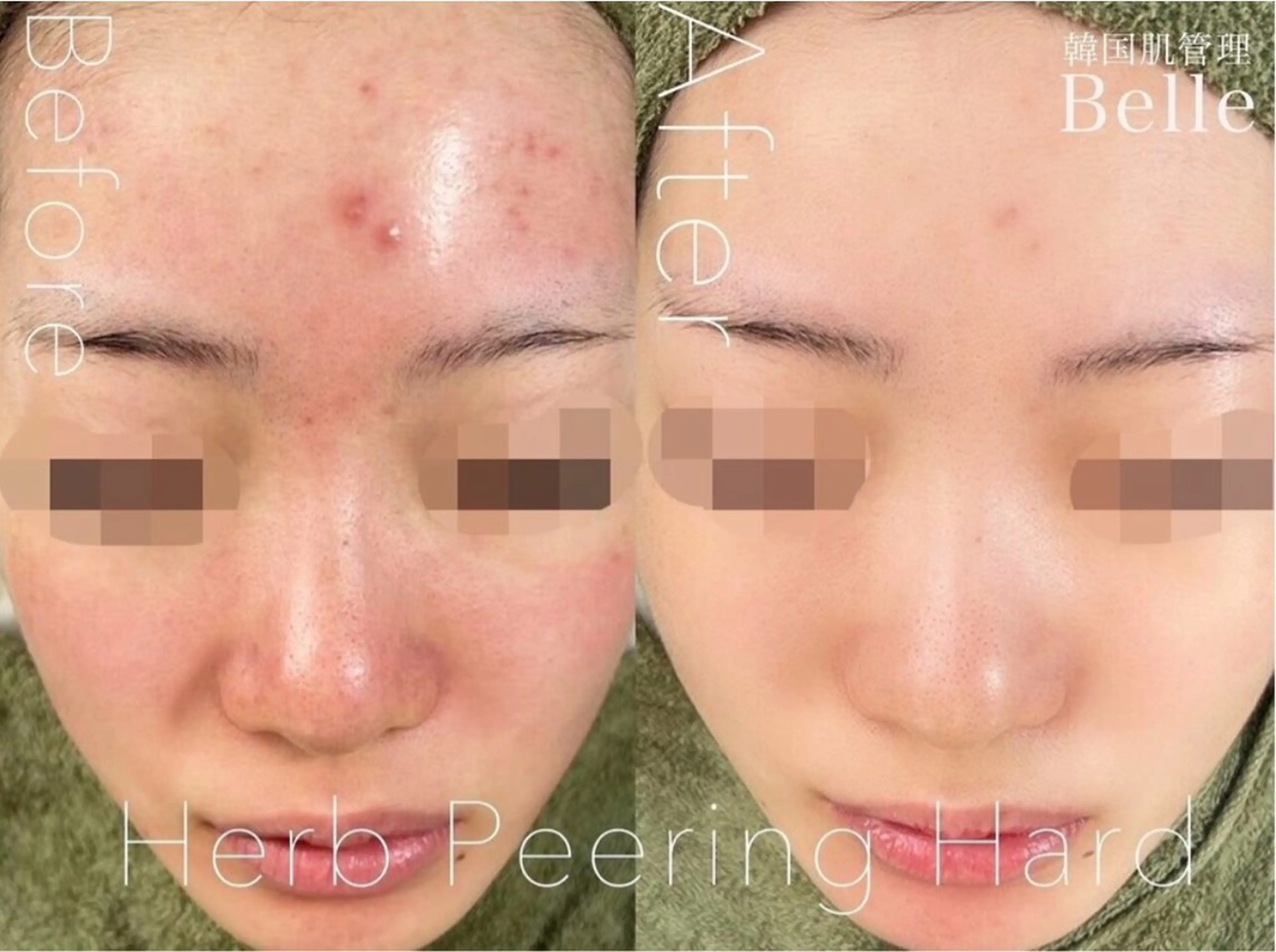 Belle目黒 /ハーブピーリングのエステ・リラクイメージ