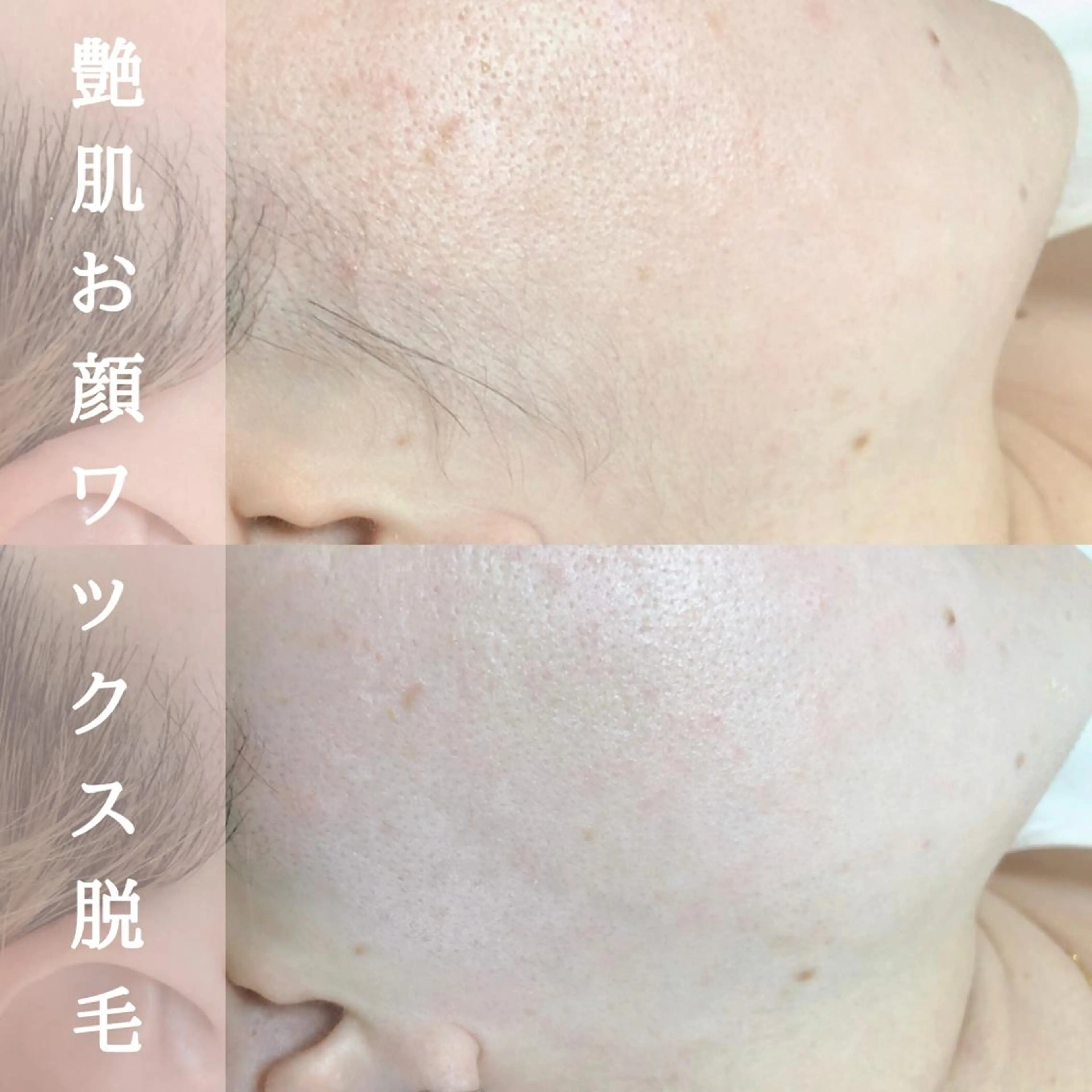 【ツヤ肌フェイシャルワックス（全顔）（顔脱毛）】つるつるアフターハイドロパック付き🥚の写真