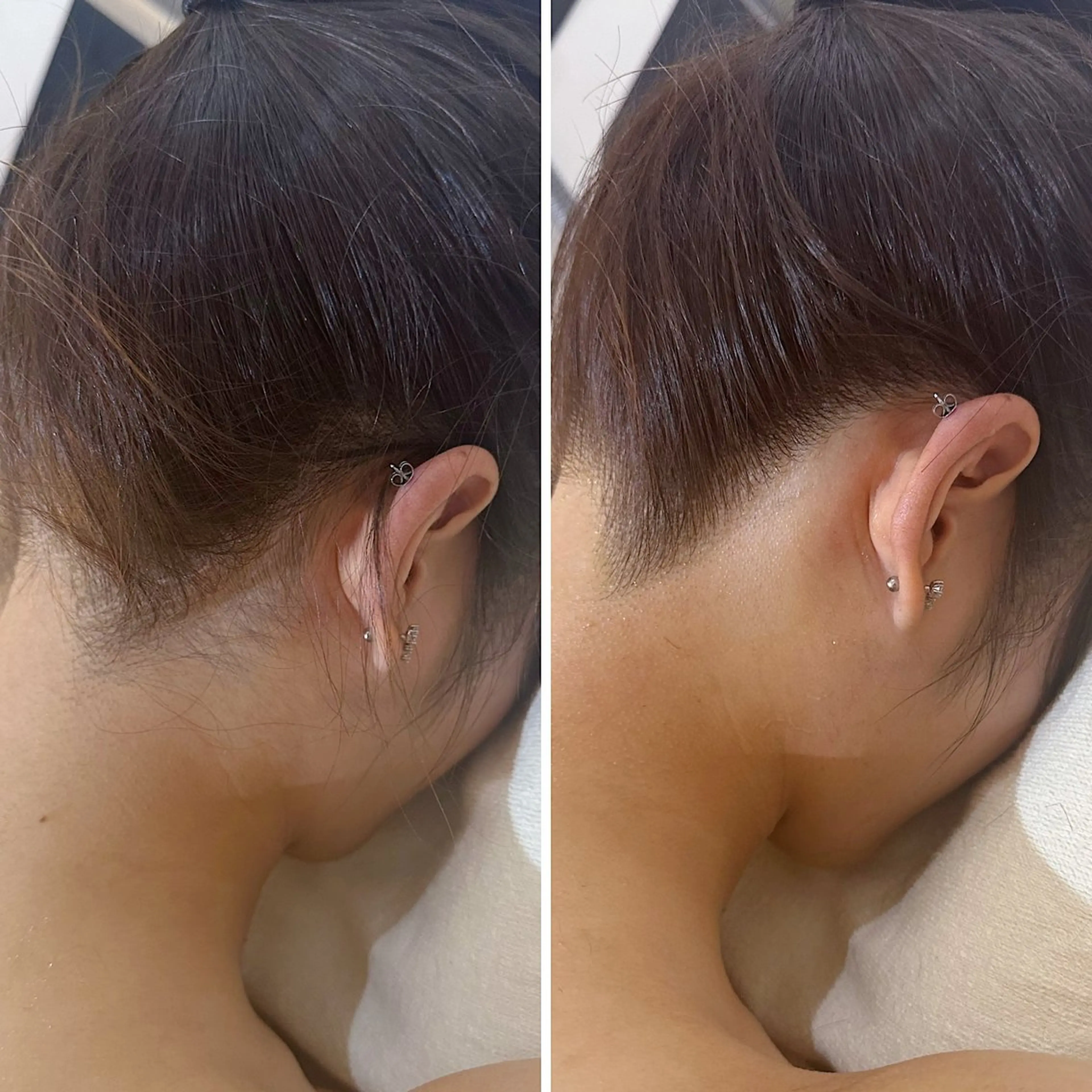 脱毛 うなじ脱毛/美肌脱毛 LABELのエステ・リラクイメージ