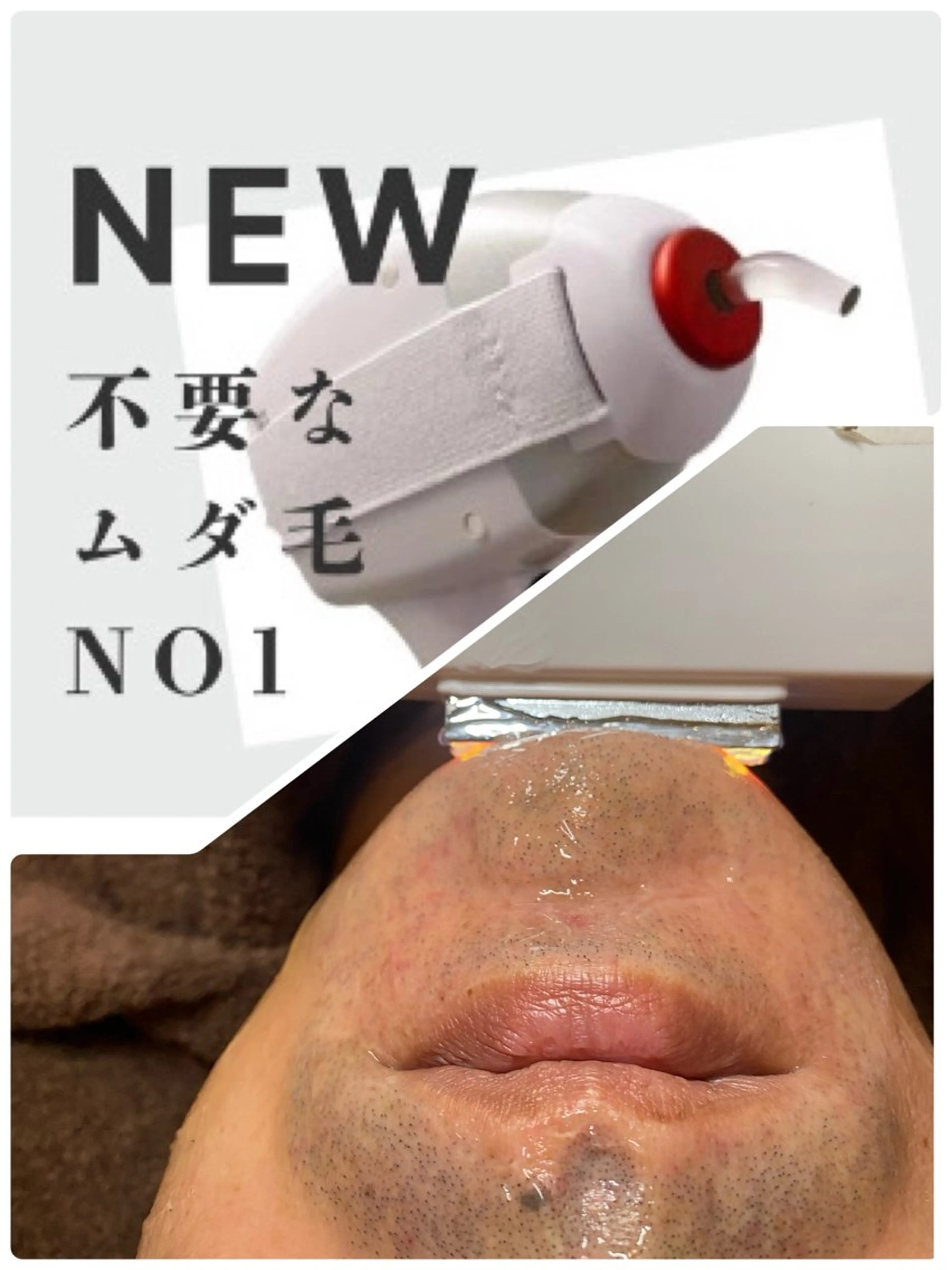 ヒゲ脱毛&鼻毛光脱毛の写真