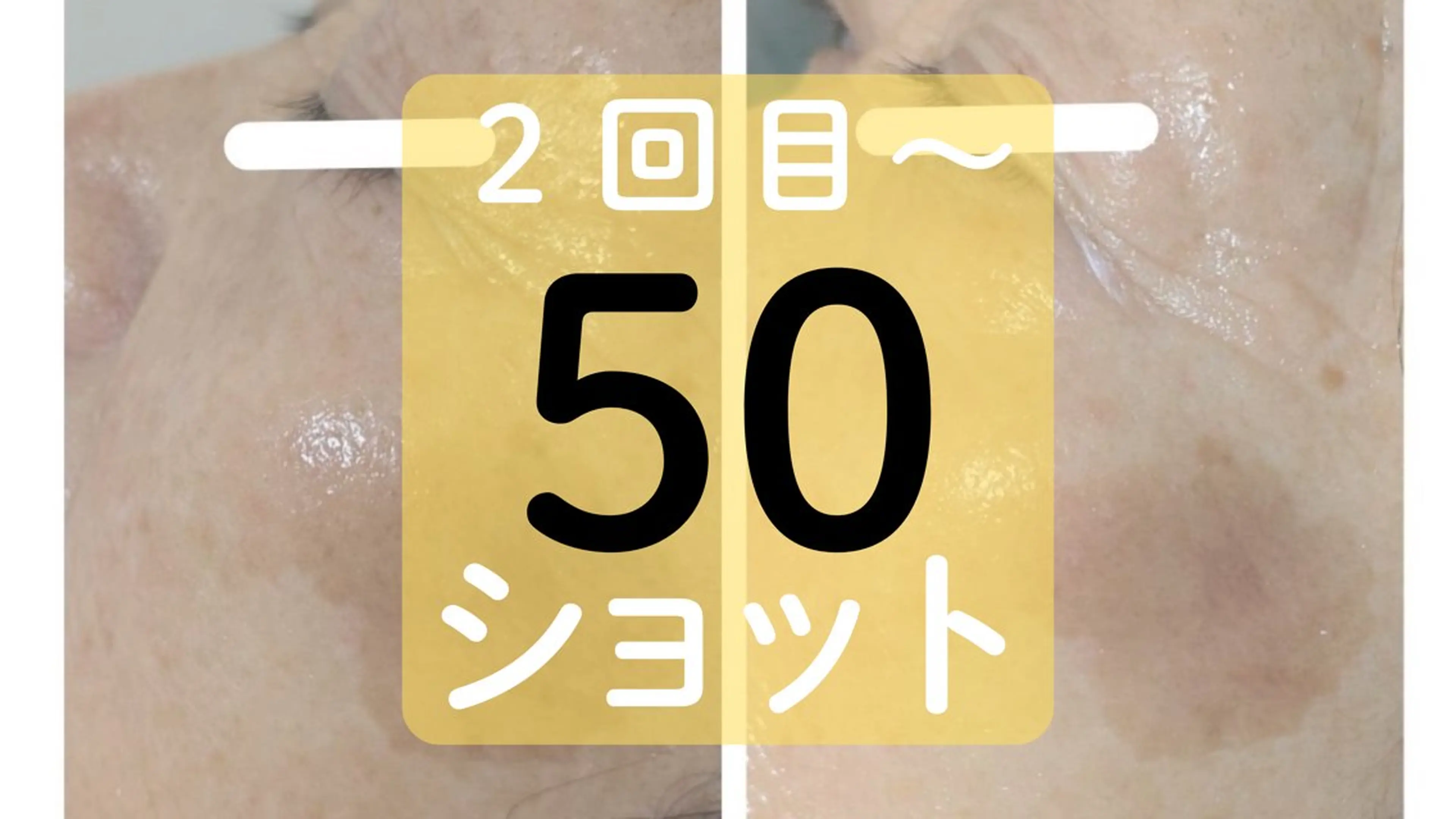 【初回価格】シワ・シミ・くすみなどお顔上部or下部のケアに 25ショットの写真