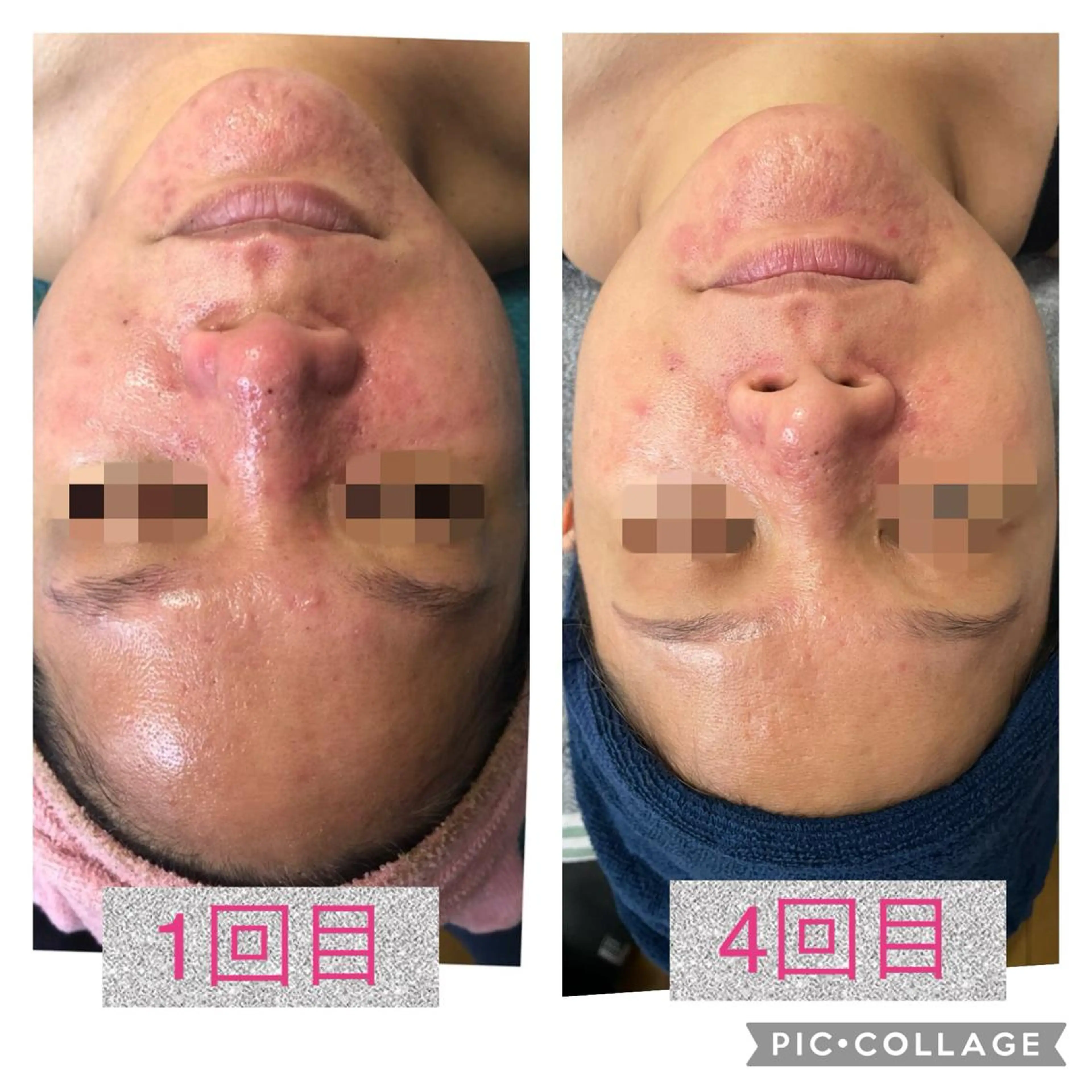 REVI陶肌トリートメントモニター4回コース✨オプションメニュー2つ🎁の写真