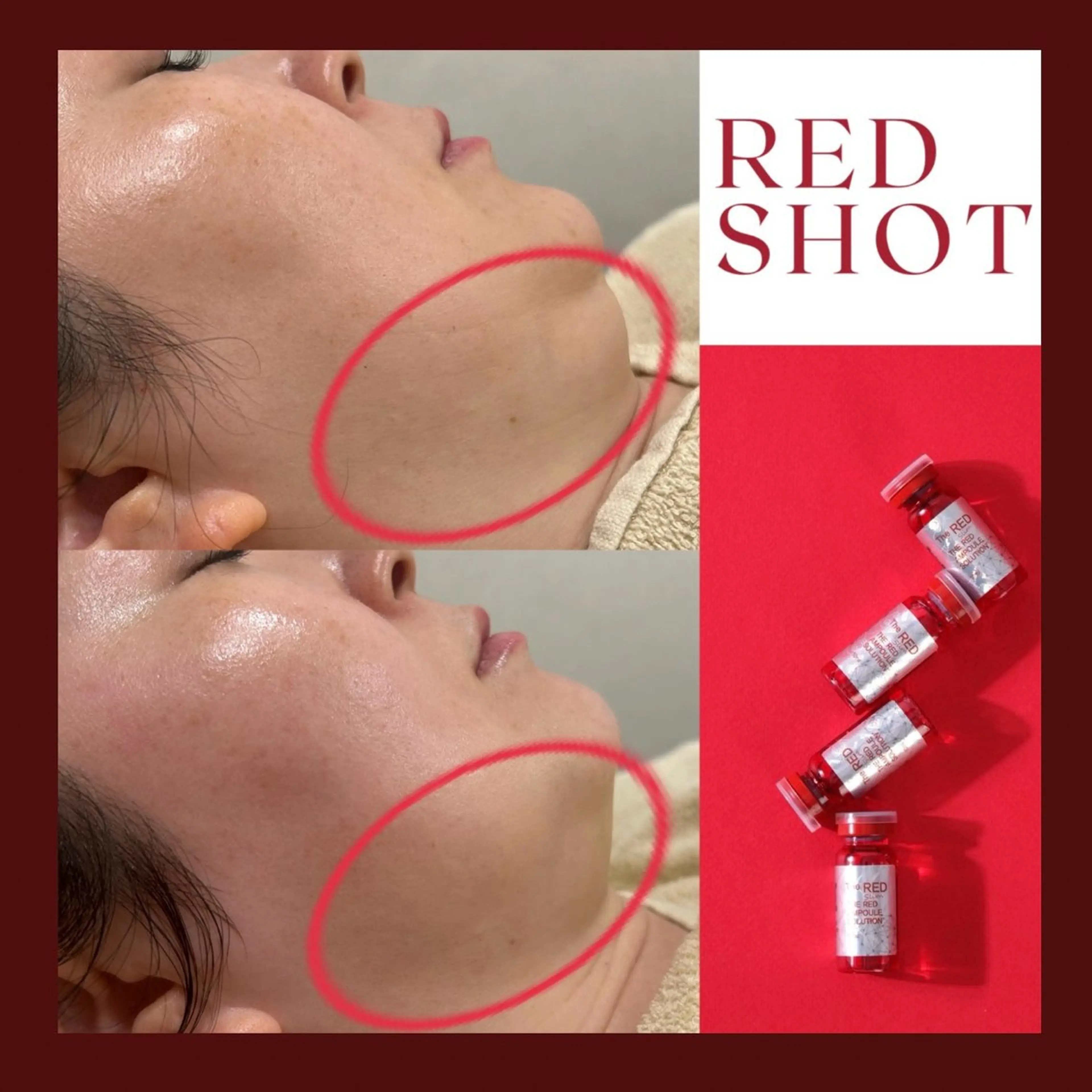 【韓国発🍋ボトル最新】二重顎撃退小顔!レッドショット❤️🔥¥16,500→¥8800の写真