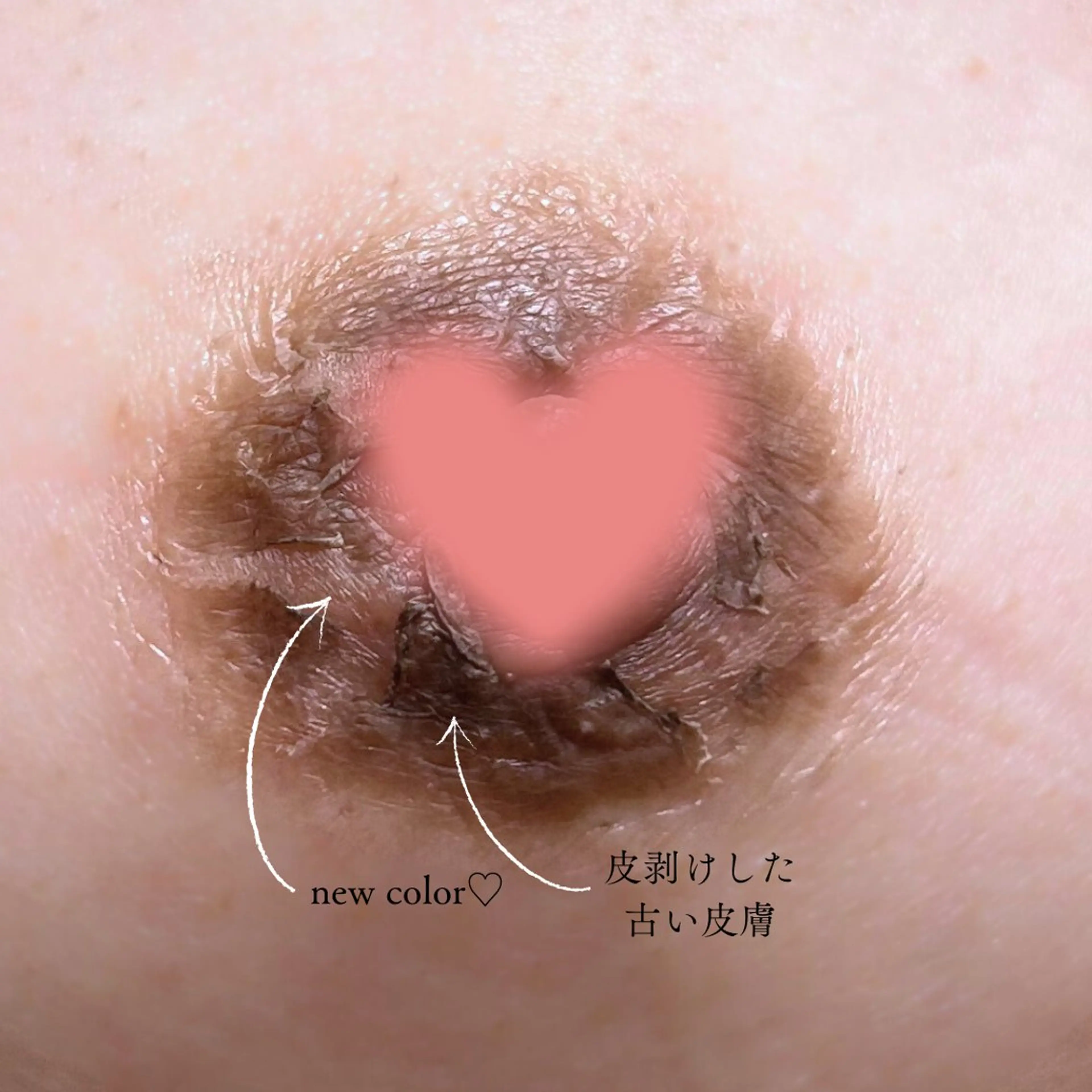 メラニンケアで色素改善🩷目指せピンクのバストトップ🩷👙の写真