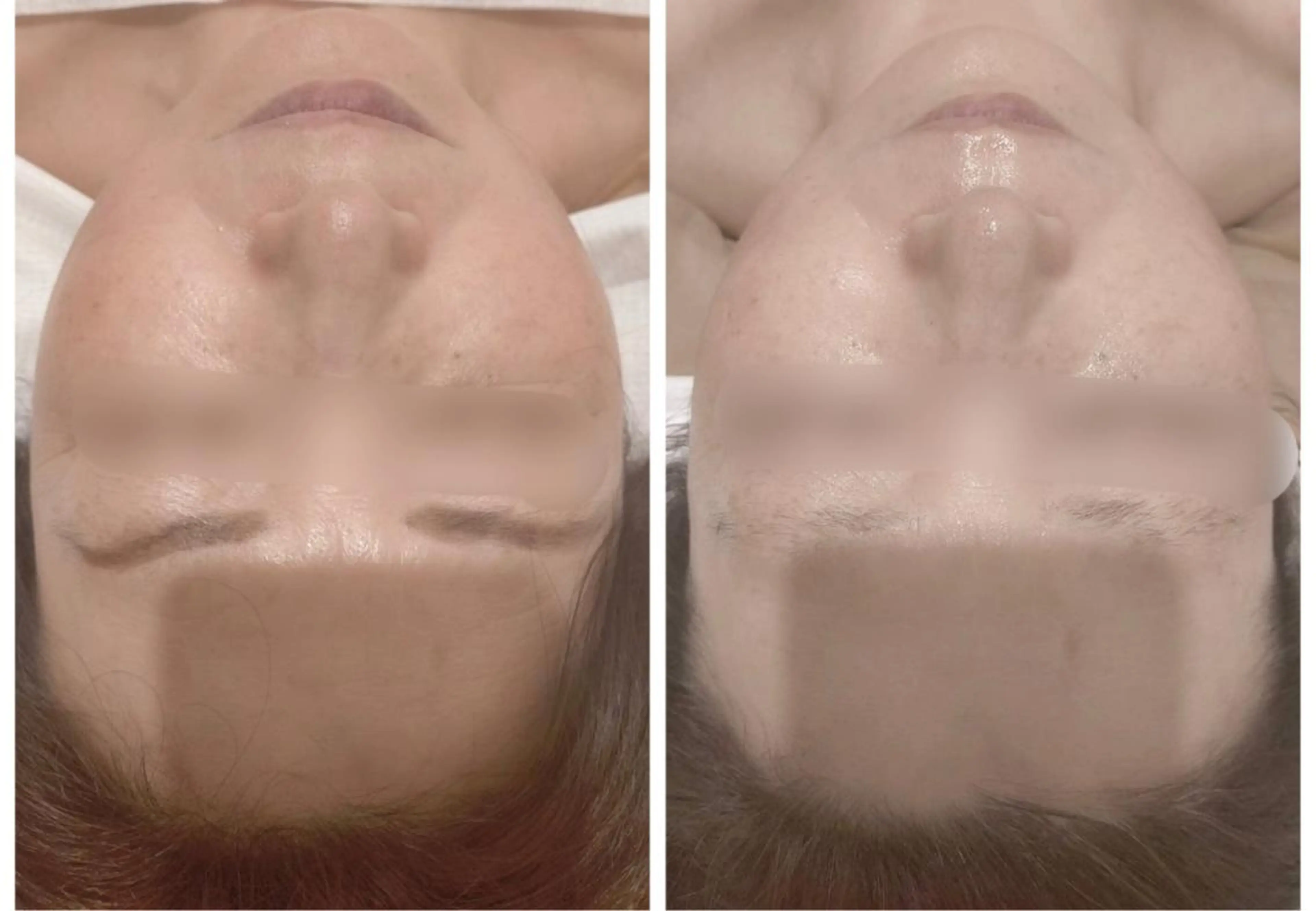 頭蓋骨小顔矯正 ハーブピーリングのエステ・リラクイメージ