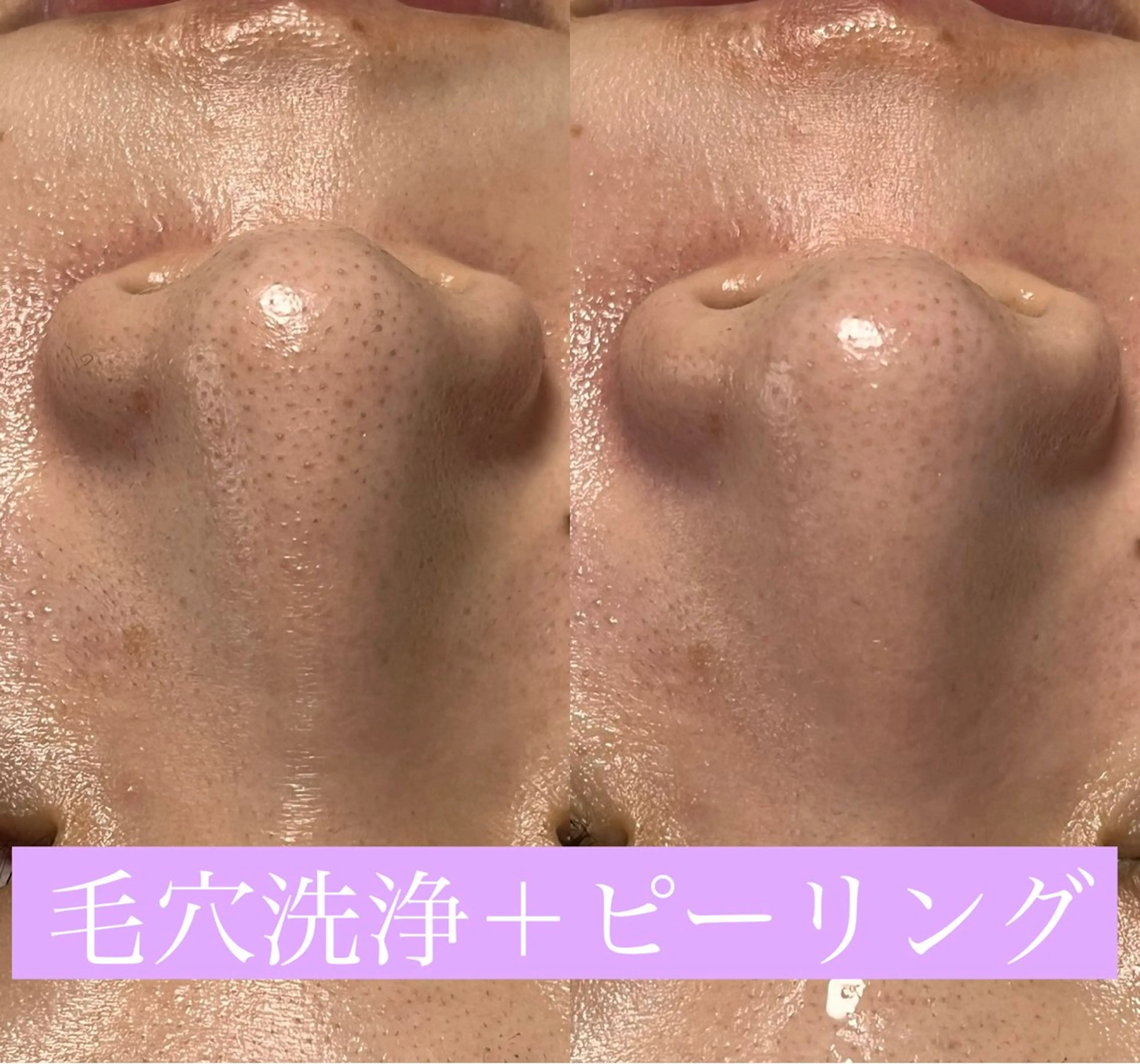 Lea Makana-レアマカナ所属・毛穴洗浄🍀脱毛🍀 光フェイシャル🍀のエステ・リラクイメージ