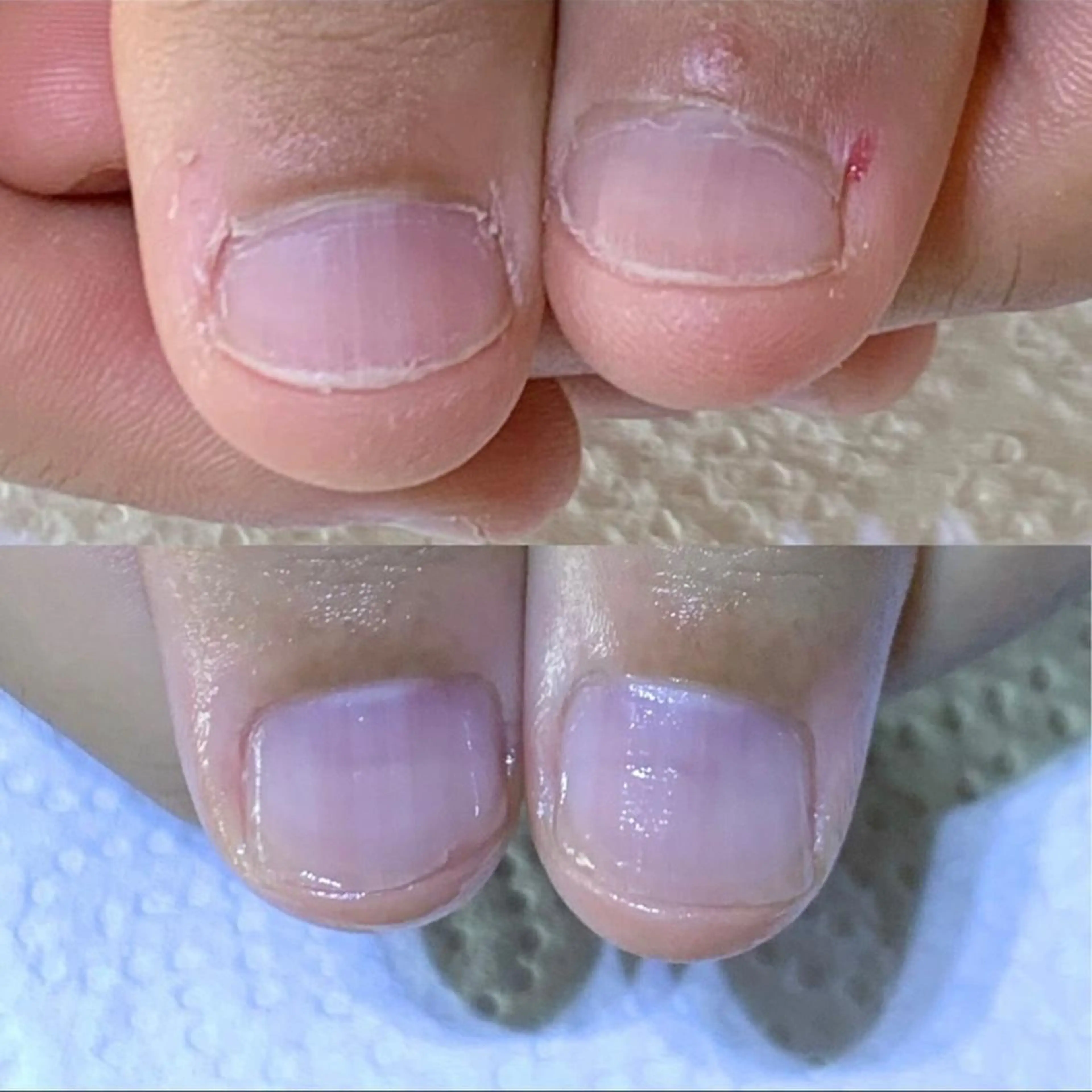 ネイル 自爪育成/深爪矯正 mikiのネイルデザイン