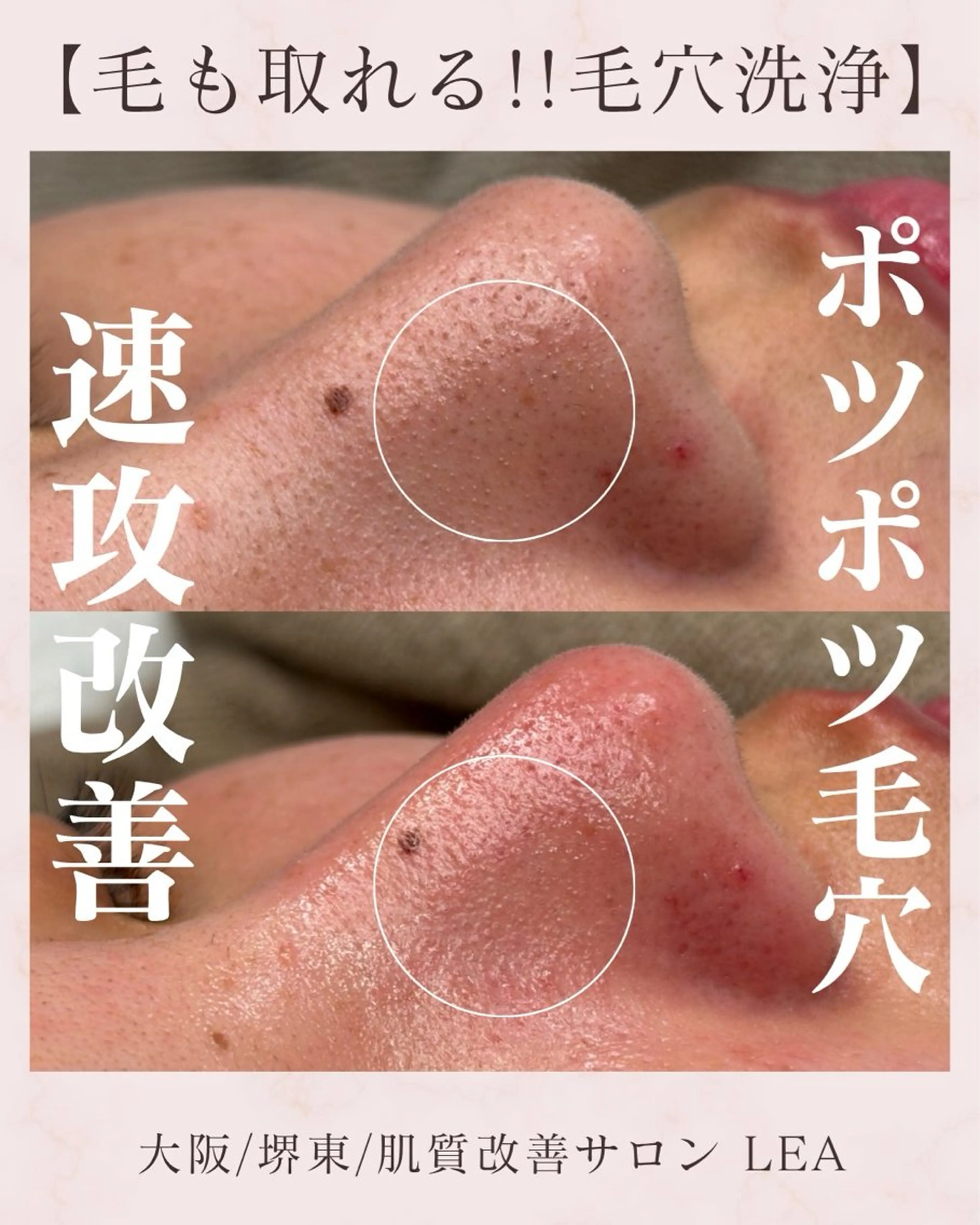 エステ Lea堺東　毛穴洗浄 ×顔ワックス脱毛のその他イメージ