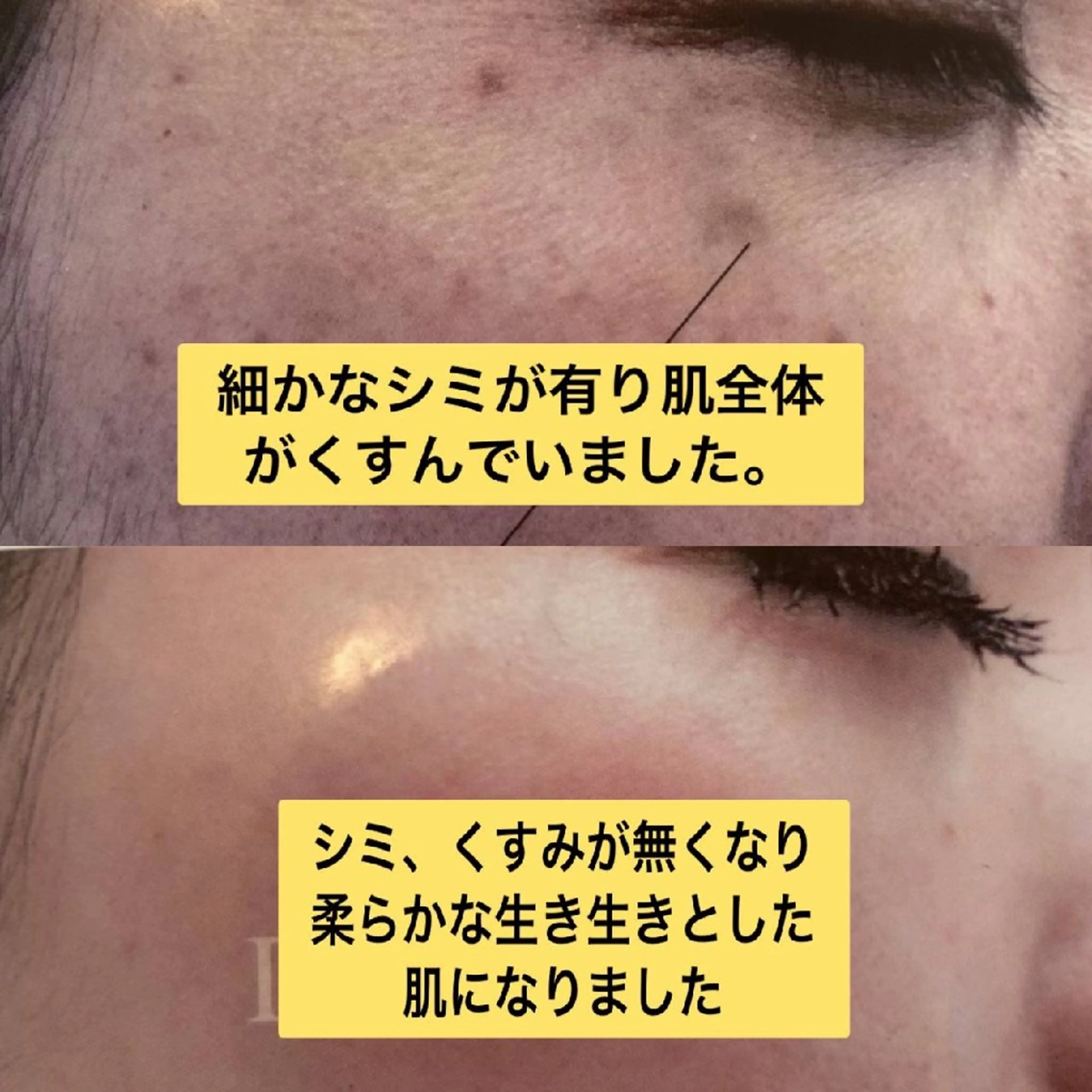 パワーライトフェイシャルの写真