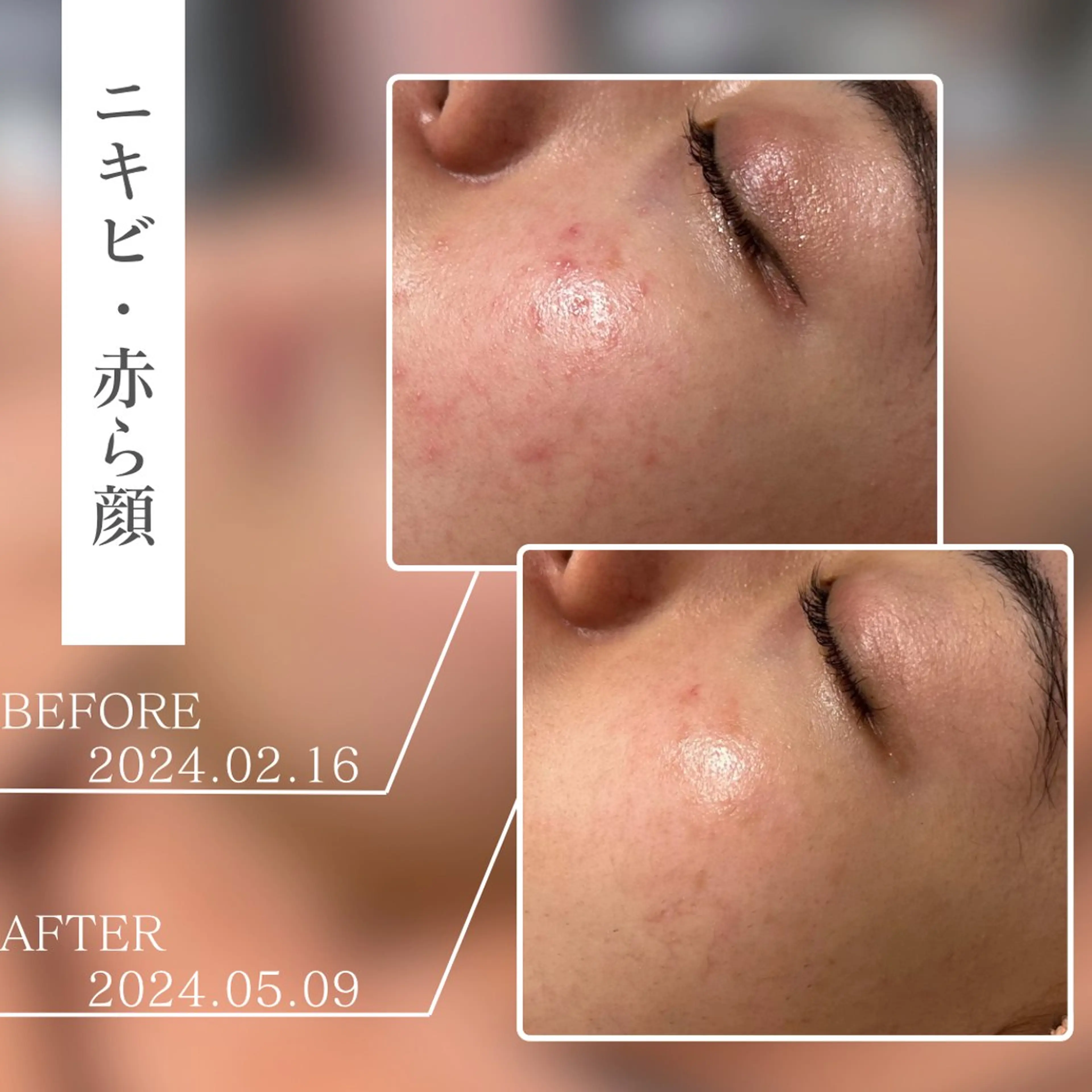 メンズ キッズ エステ BestBelleꕤ 大阪福島/肌質改善のエステ・リラクイメージ