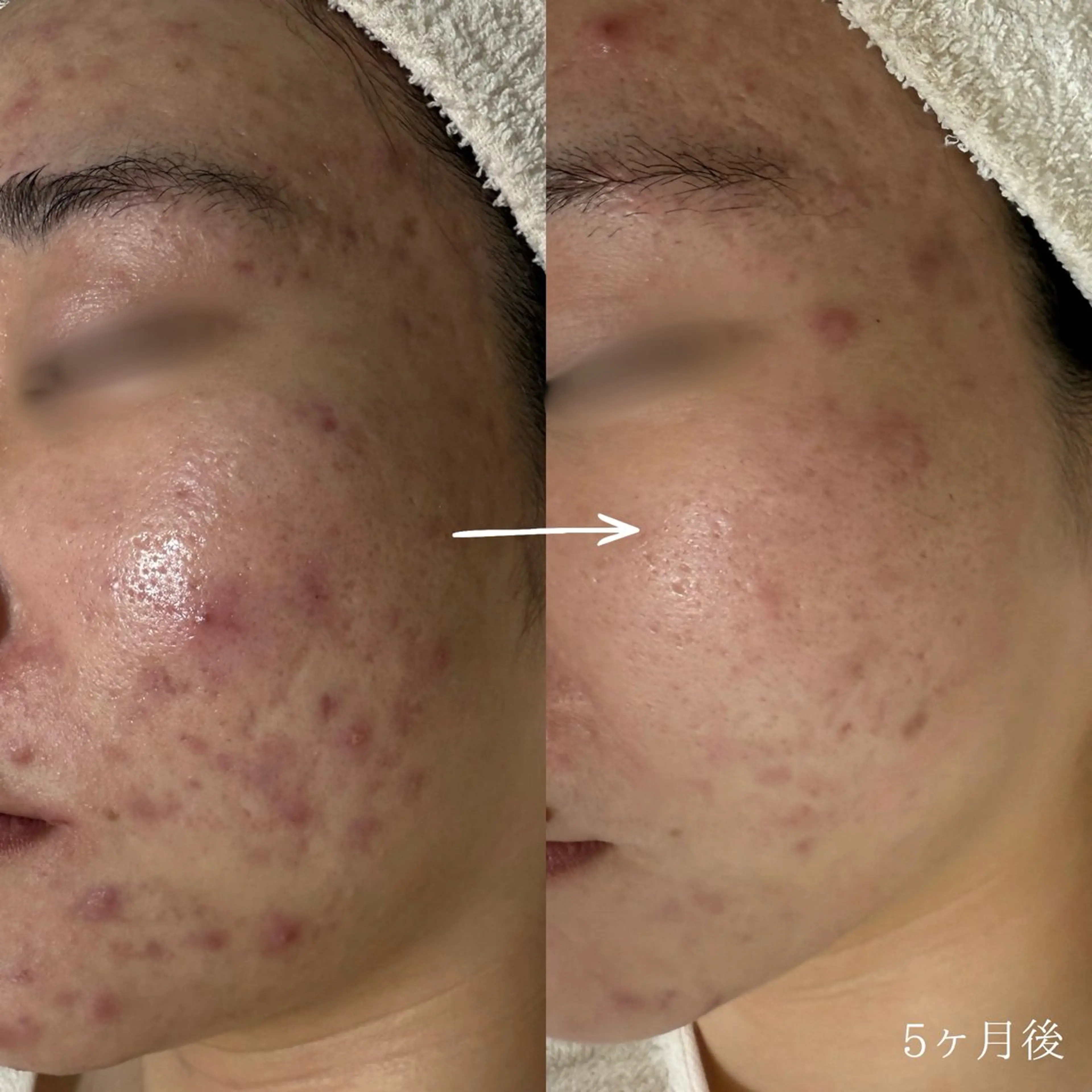 ニキビ・毛穴・ フェイシャル専門店のエステ・リラクイメージ